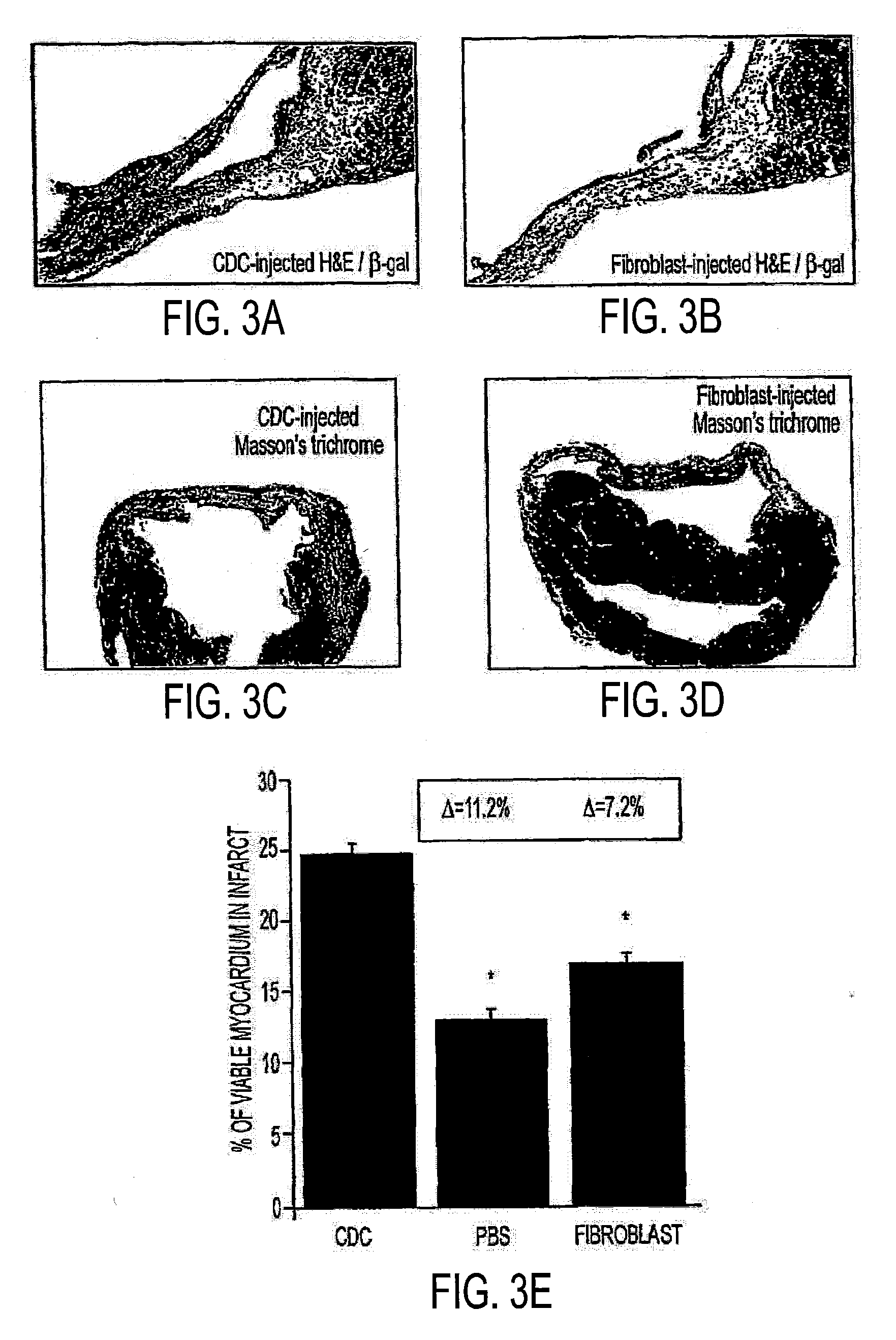 Methods of Reducing Teratoma Formation During Allogeneic Stem Cell Therapy