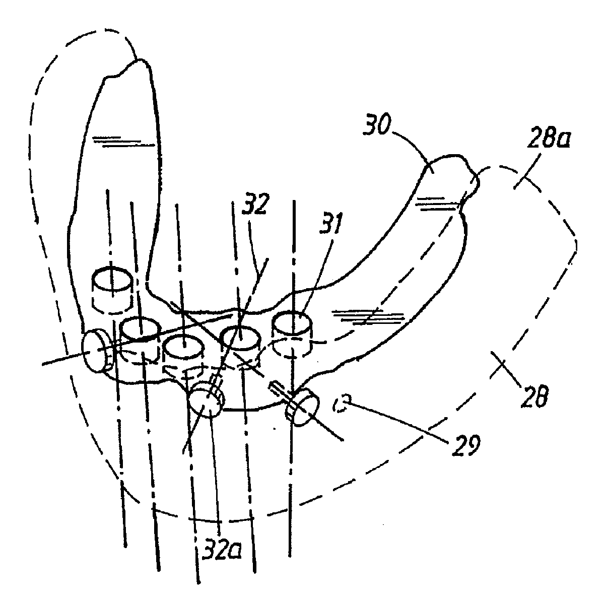 Arrangement and device for using a template to form holes for implants in bone, preferably jaw bone