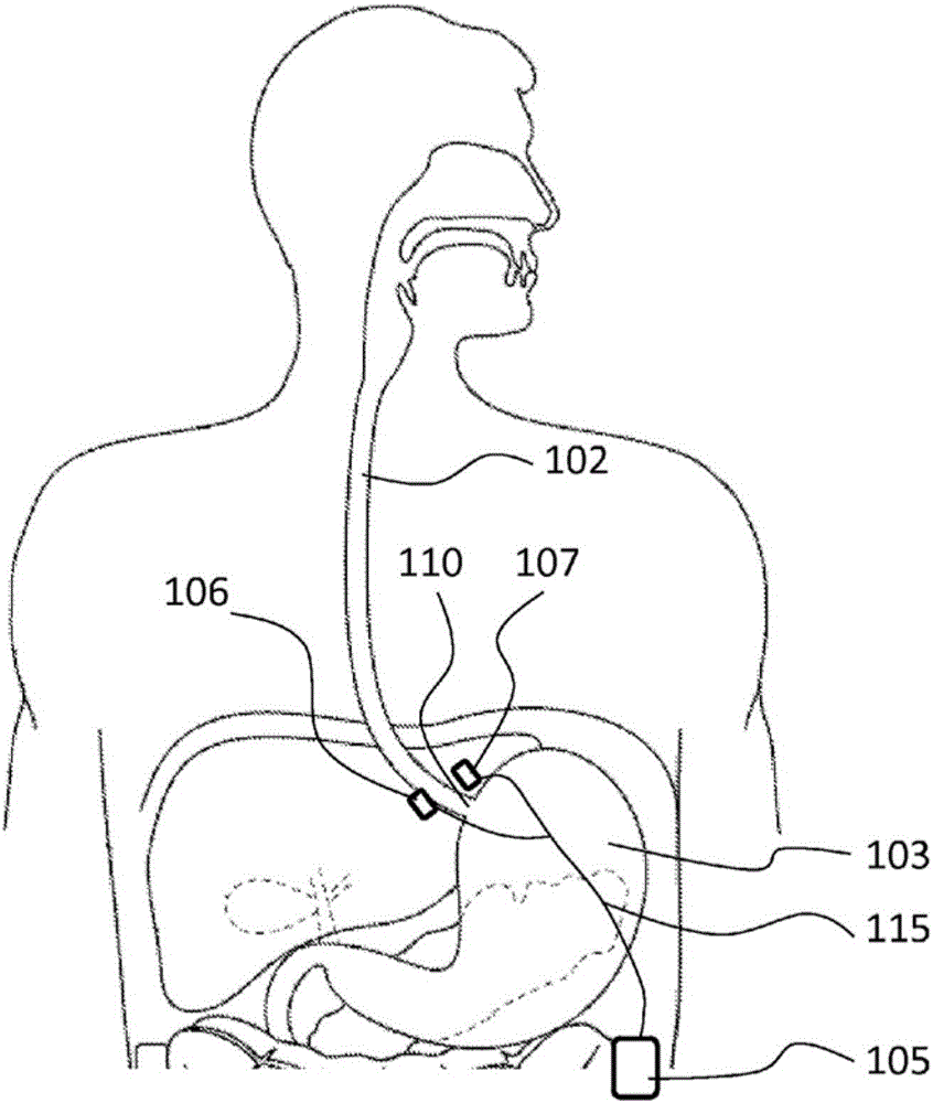 Methods and systems of electrode polarity switching in electrical stimulation therapy