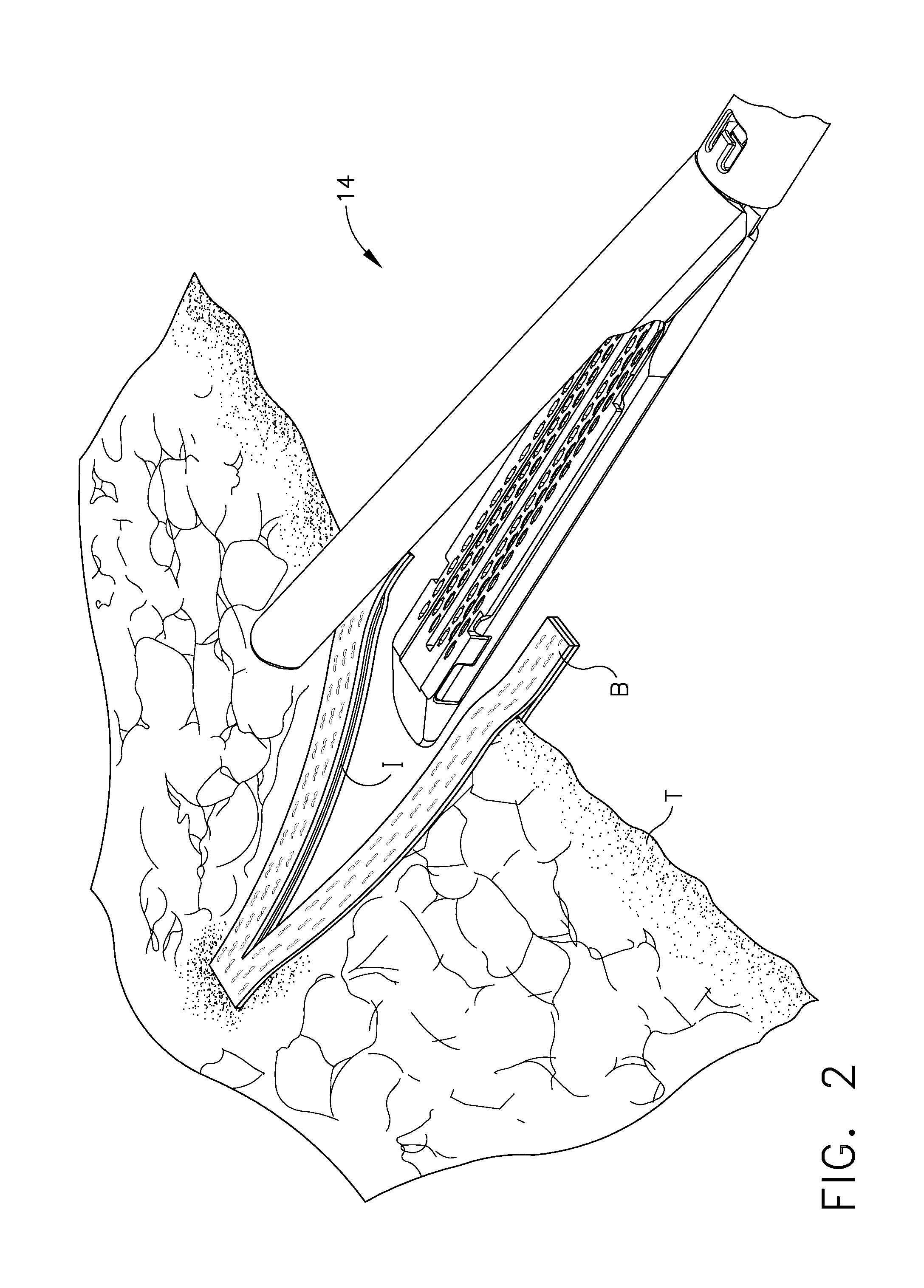 Buttress material for a surgical instrument