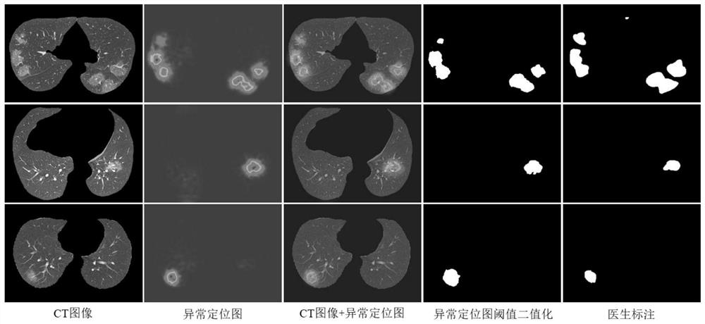 Lung disease lesion unsupervised segmentation method based on knowledge distillation