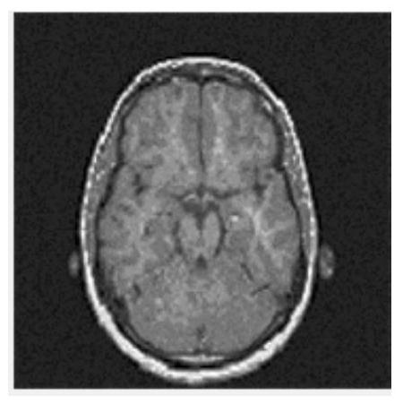 PHTs-DCT-based medical image robust watermarking method