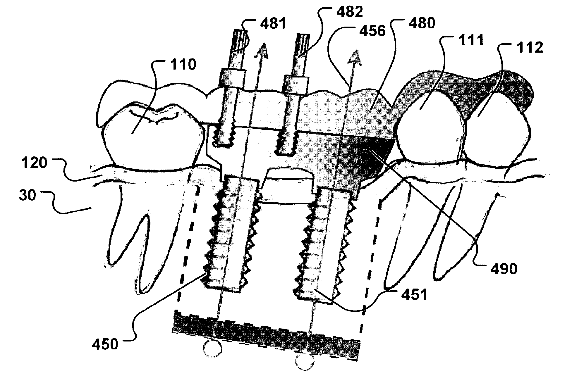 Computer implemented planning and providing of mass customized bone structure