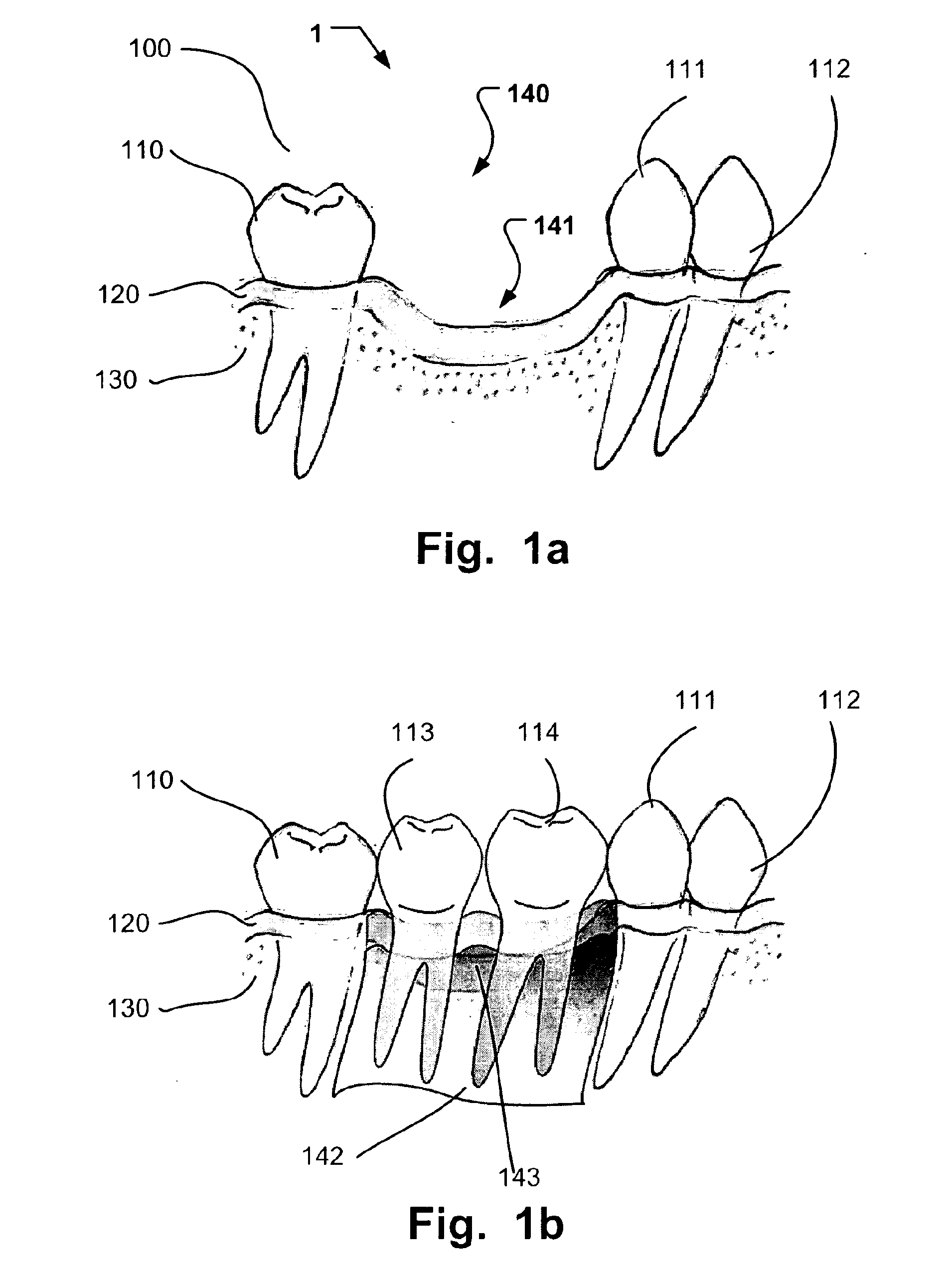 Computer implemented planning and providing of mass customized bone structure