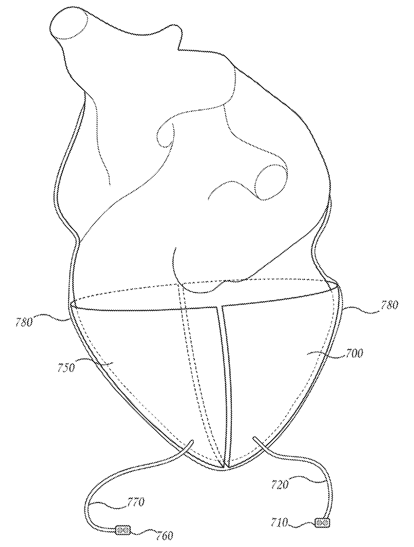 Pericardial inserts