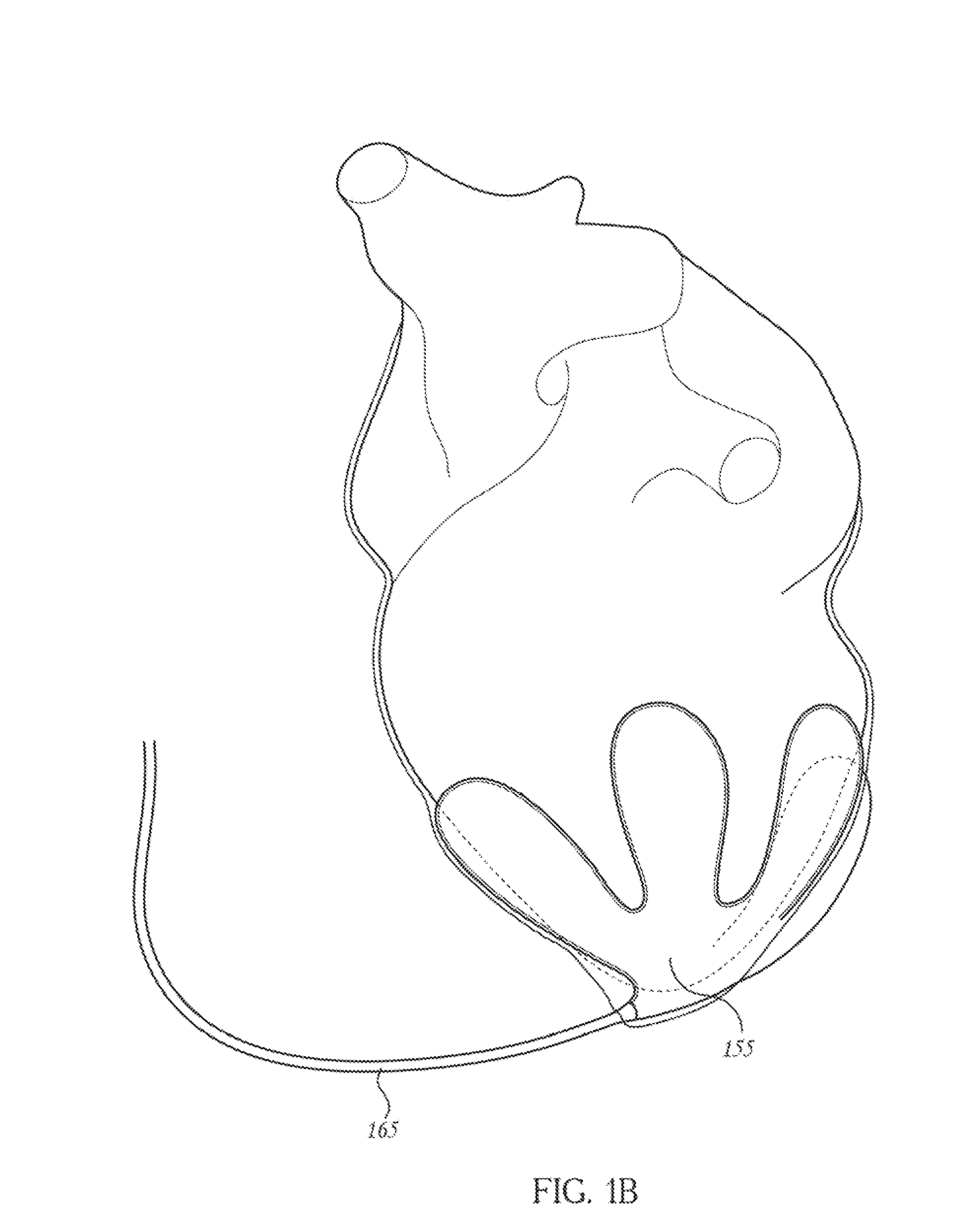 Pericardial inserts