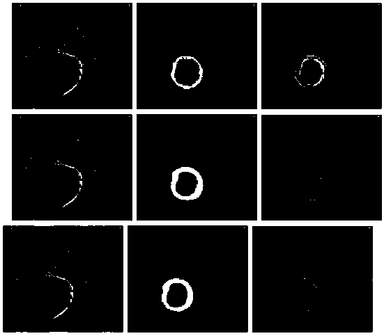 DCM myocardial diagnosis and treatment radiation image segmentation method based on a multi-scale feature pyramid