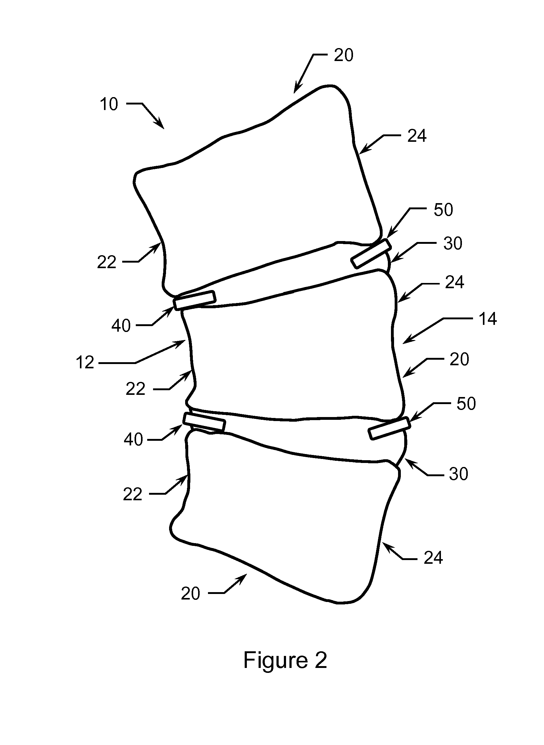 Method of treating scoliosis using a biological implant