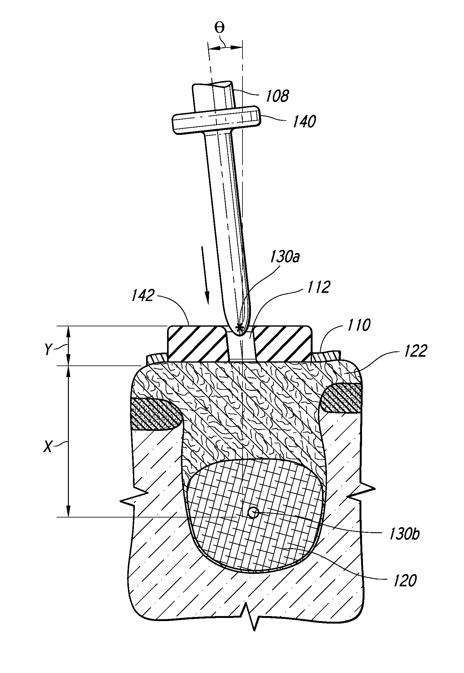 Therapeutic Tooth Bud Ablation