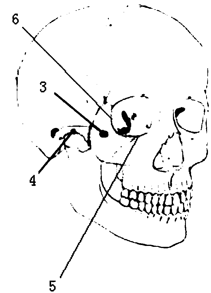 Mask for zygomatic fracture outer fixed healing and fixed healing system