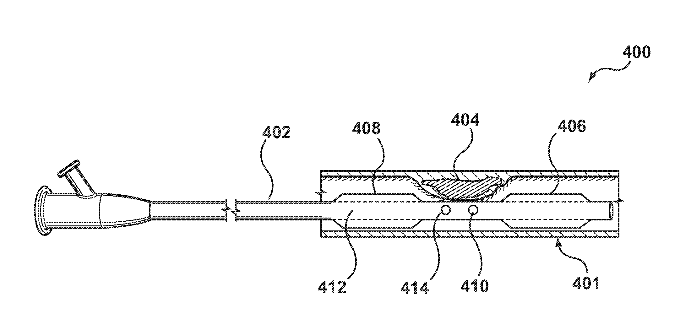 Method and Device for Localized Administration of Calcium Chelating Agent