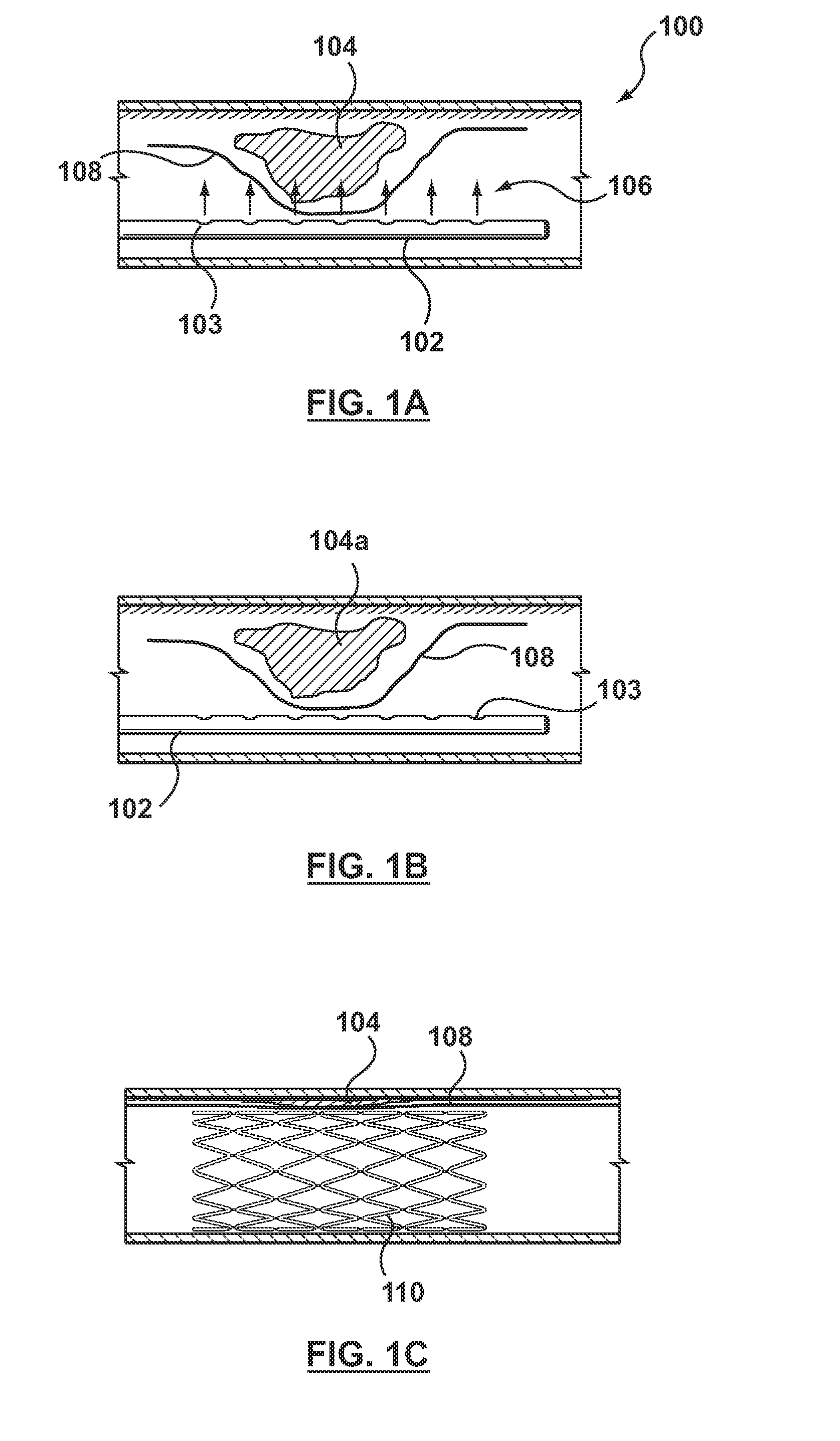 Method and Device for Localized Administration of Calcium Chelating Agent