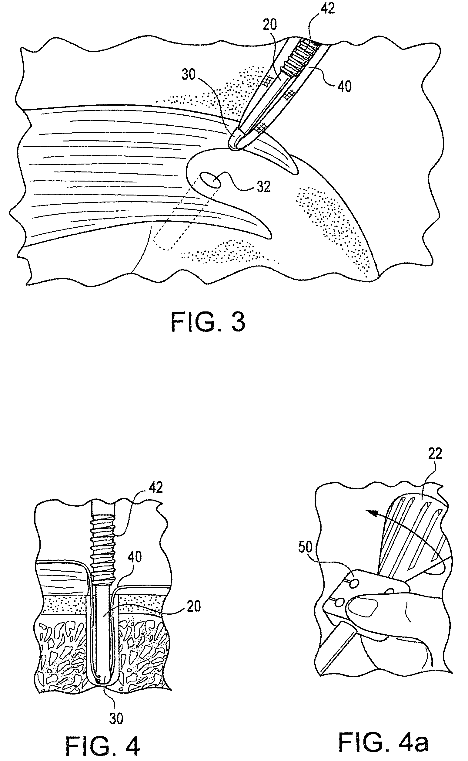 Swivel anchor for knotless fixation of tissue