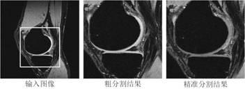 Automatic segmentation method for articular cartilage tissue in three-dimensional medical image