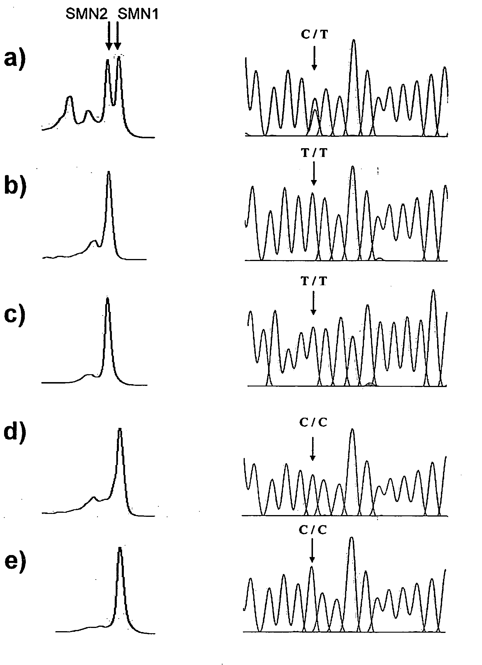 Methods for SMN genes and spinal muscular atrophy carriers screening