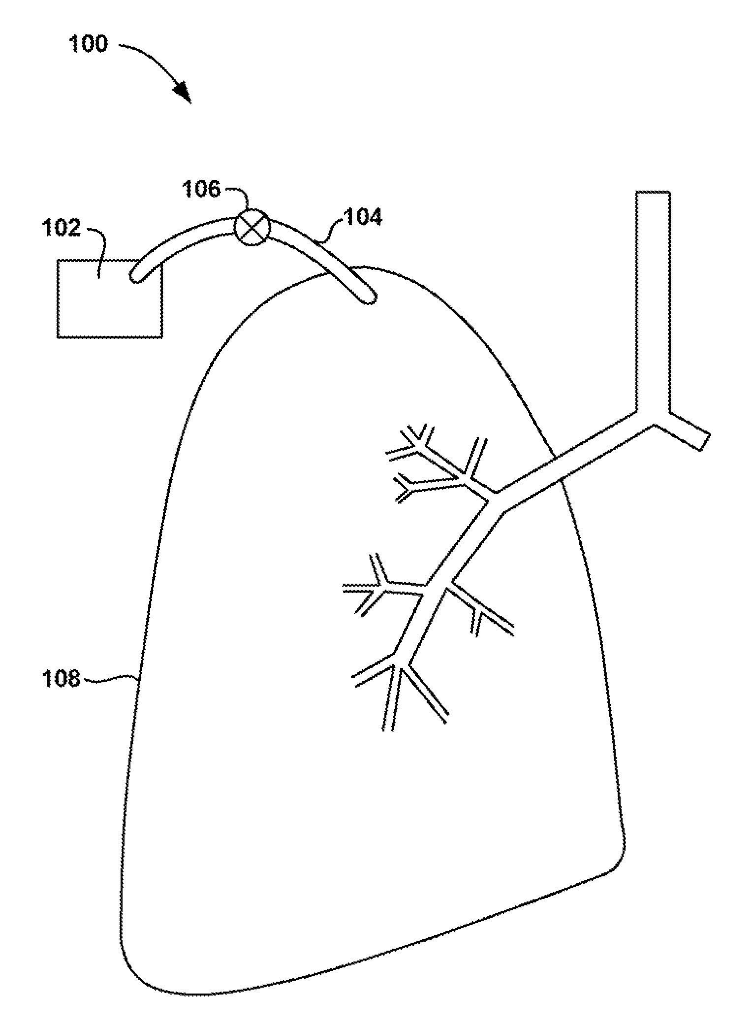 Visceral pleura ring connector