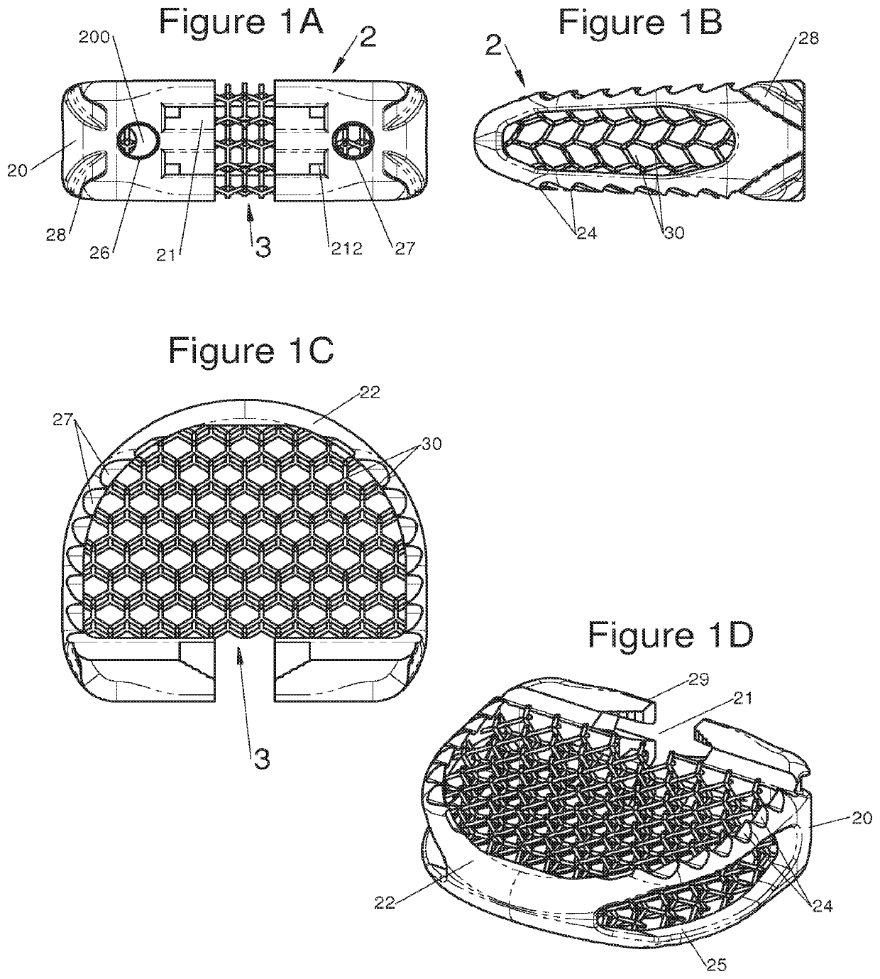 Vertebral system, implant and inserts for vertebral system