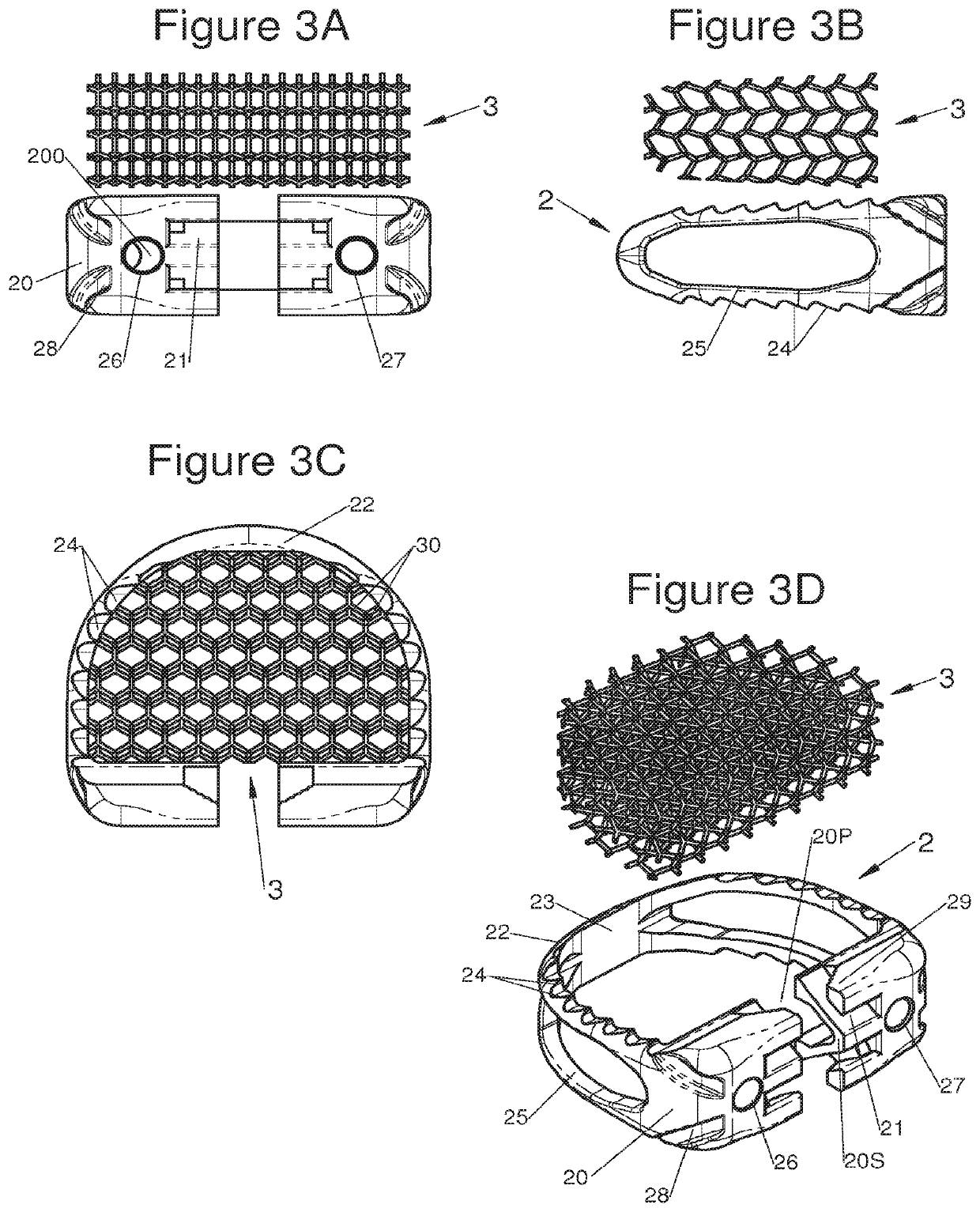 Vertebral system, implant and inserts for vertebral system