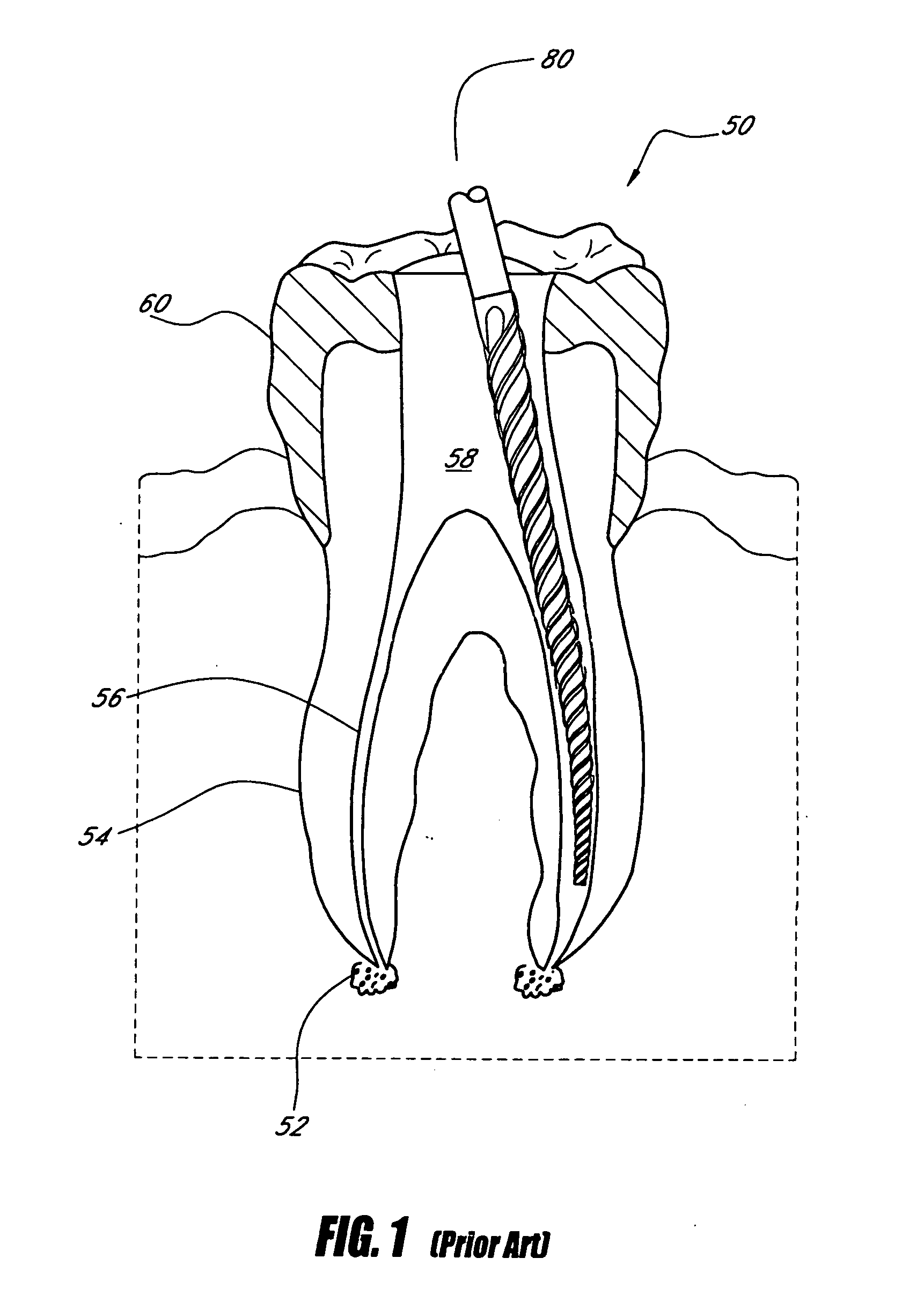 Endodontic instrument having notched cutting surfaces