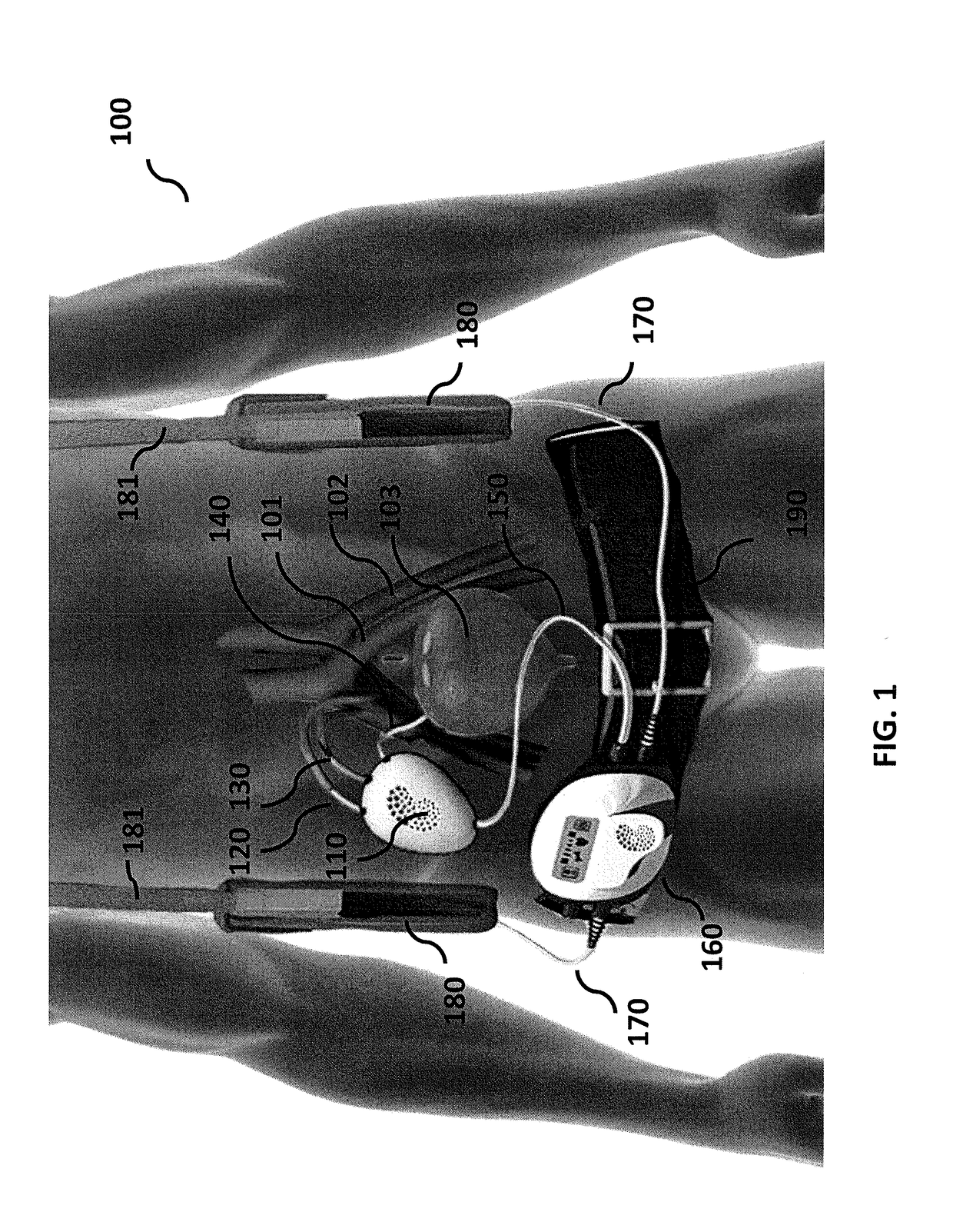 Implantable renal replacement therapy