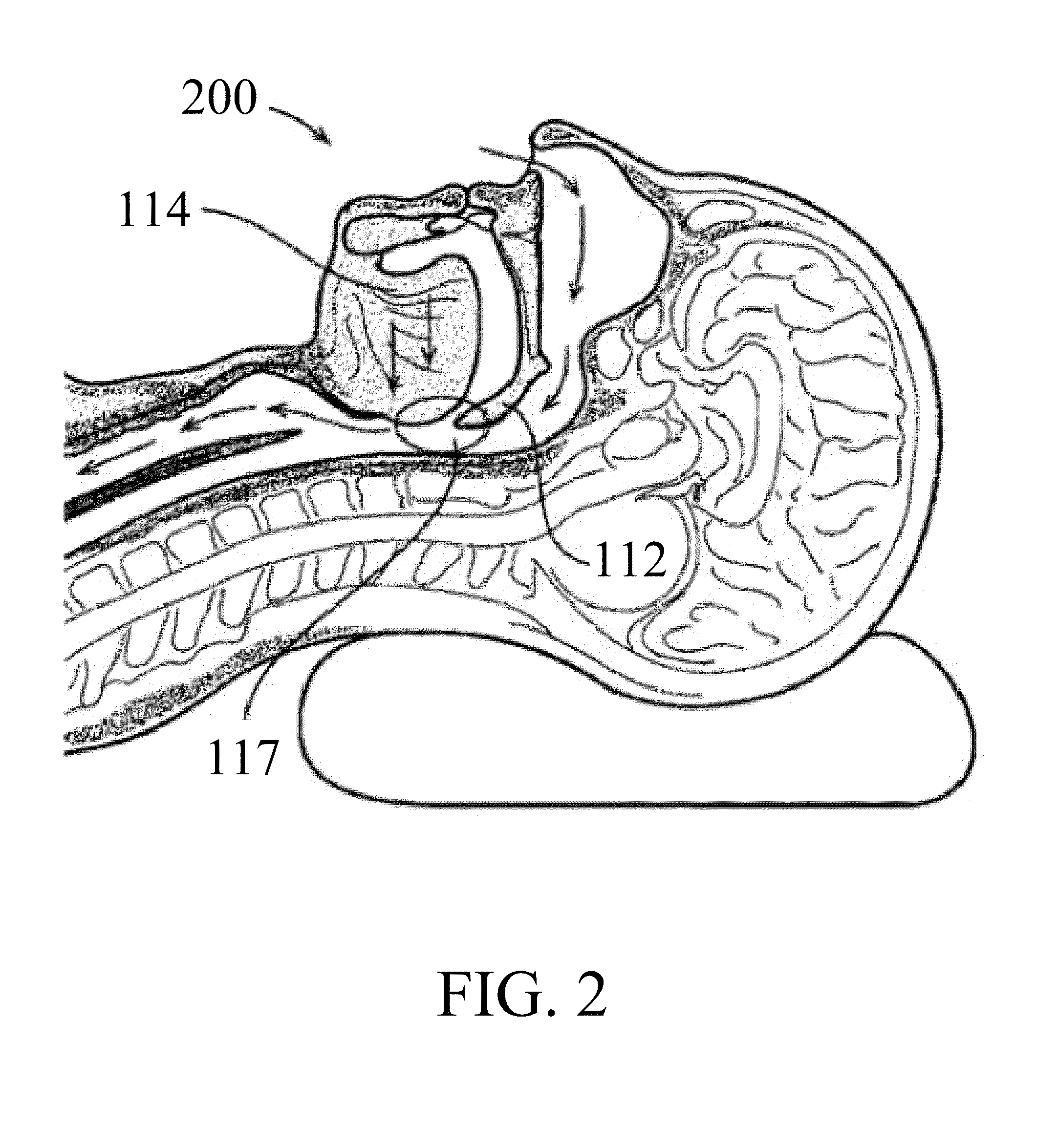 Device for snoring and obstructive sleep apnea treatment