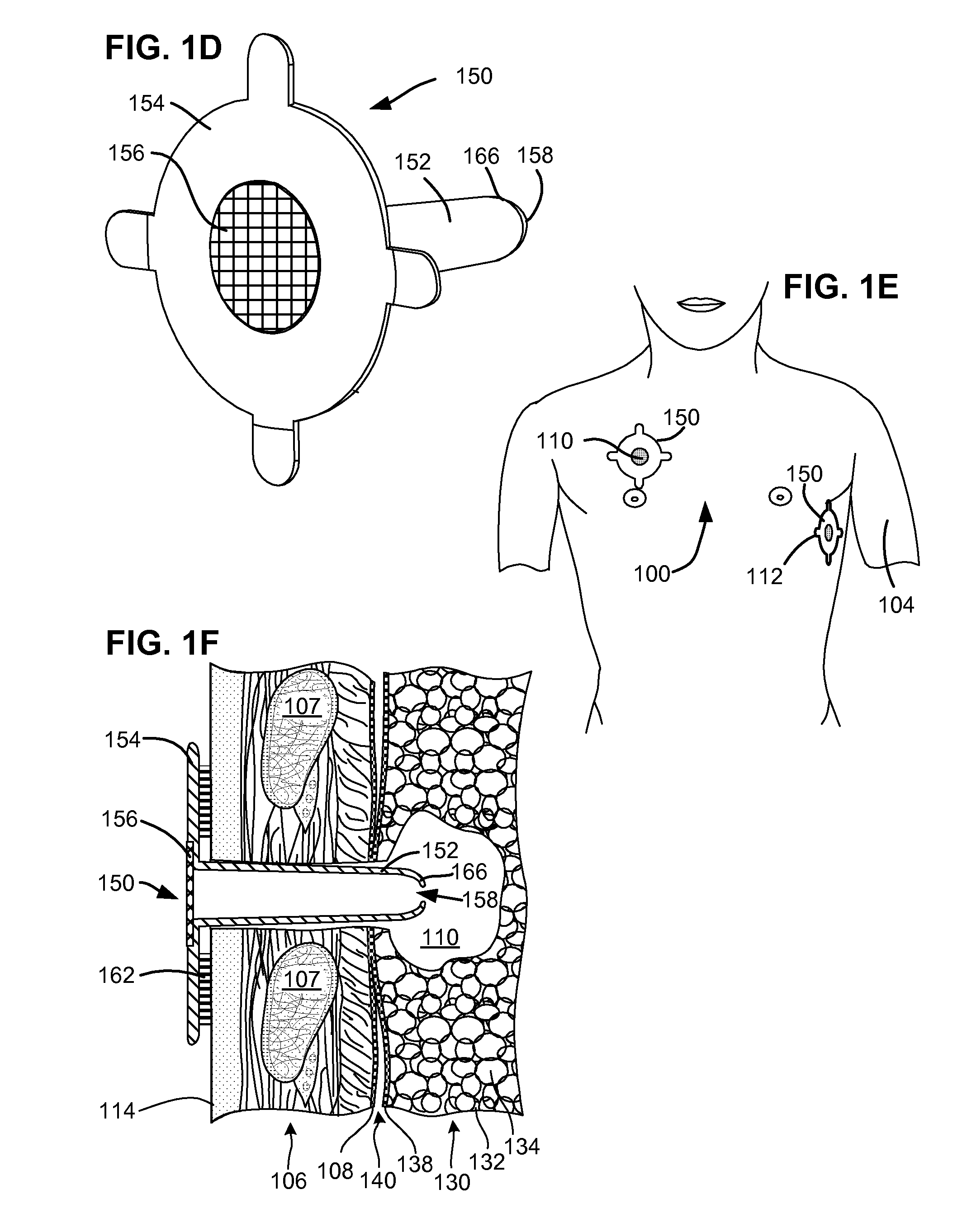 Methods and devices for assessment of pneumostoma function