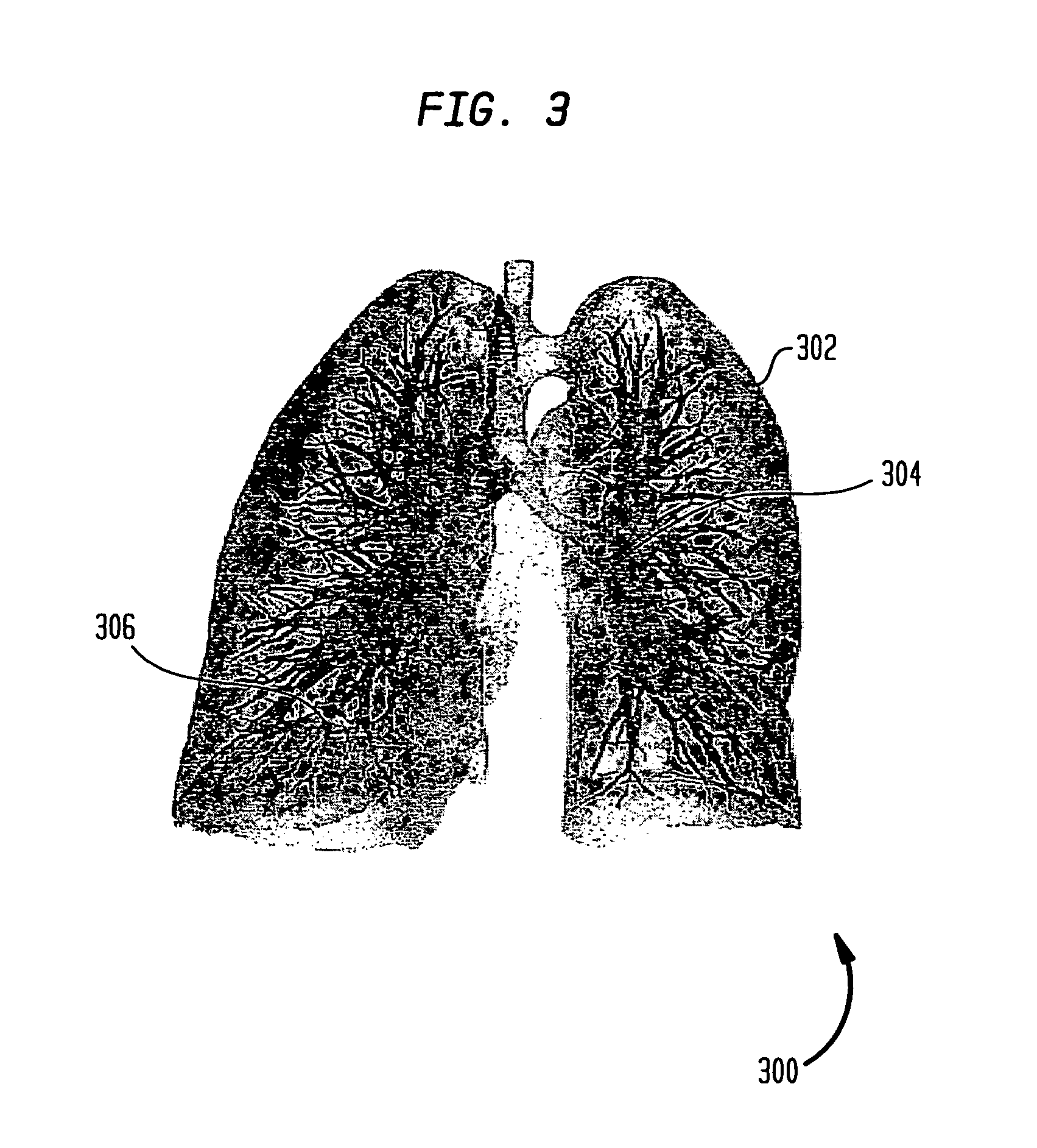 Method and apparatus for embolism analysis