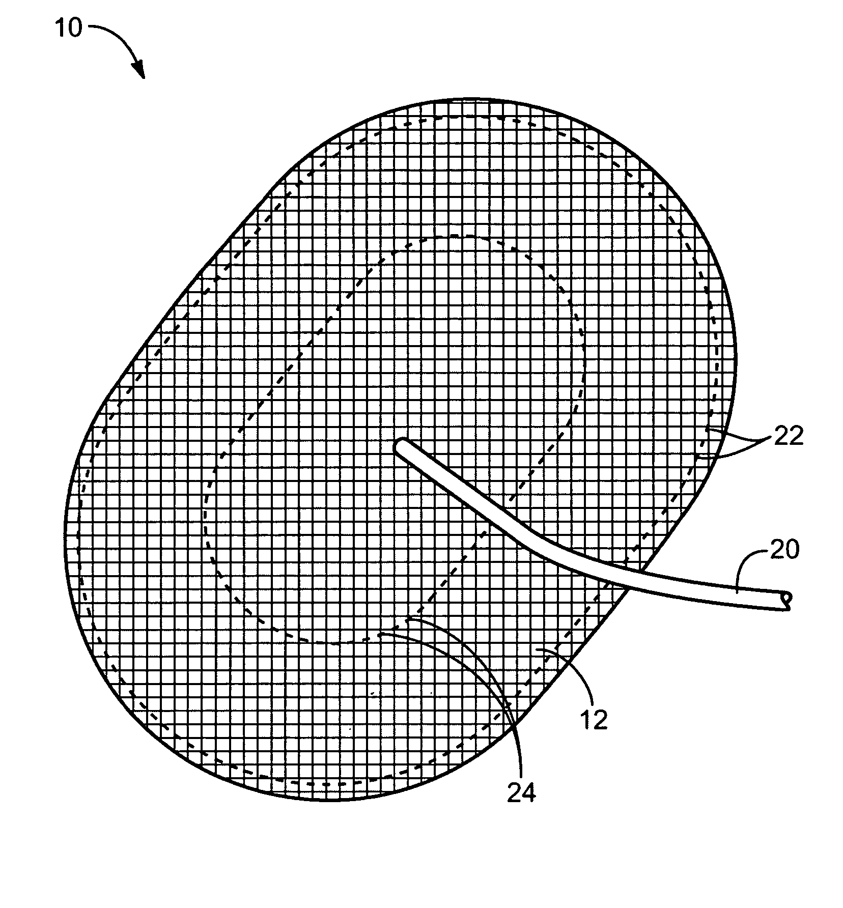 Inflatable hernia patch