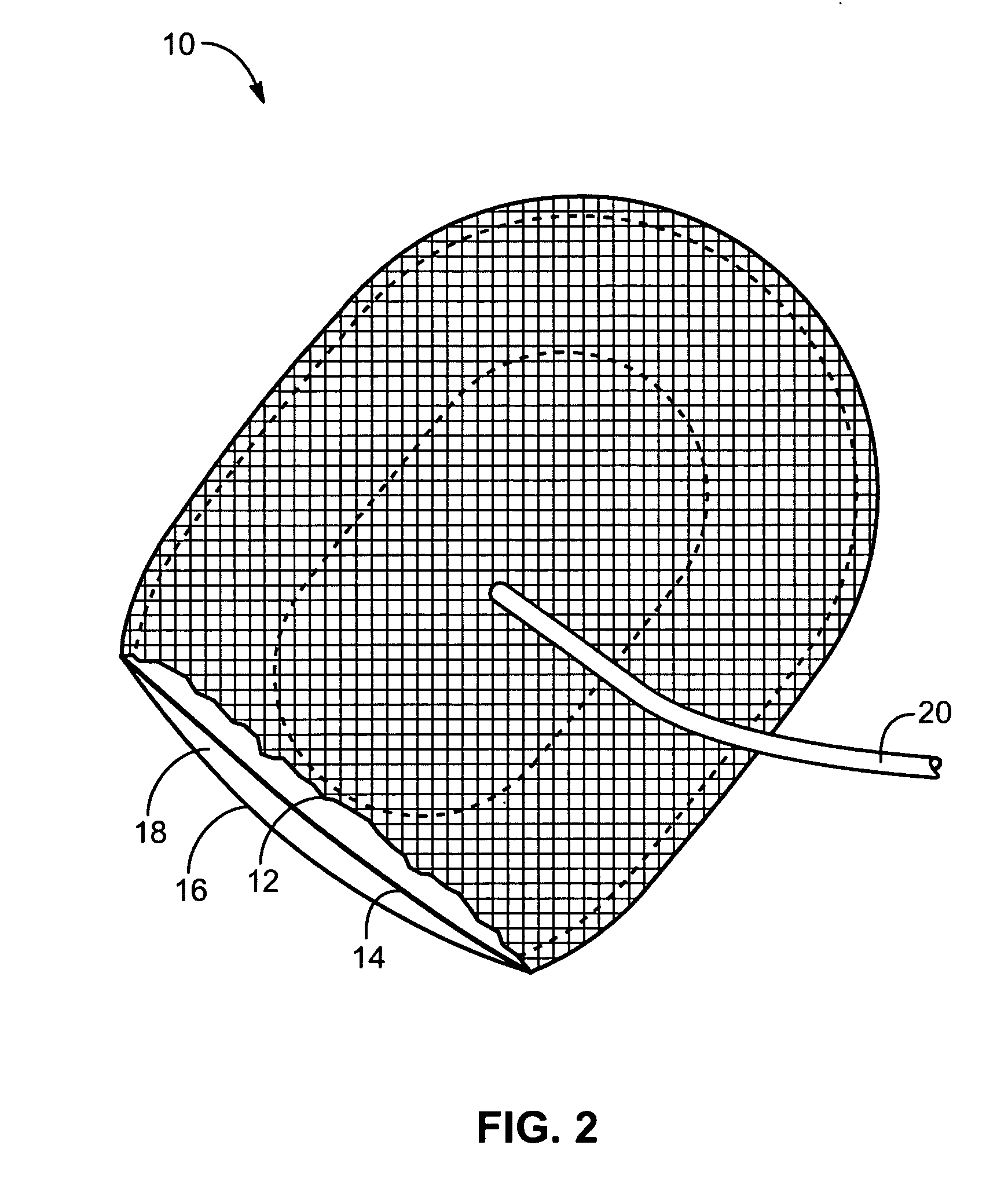 Inflatable hernia patch