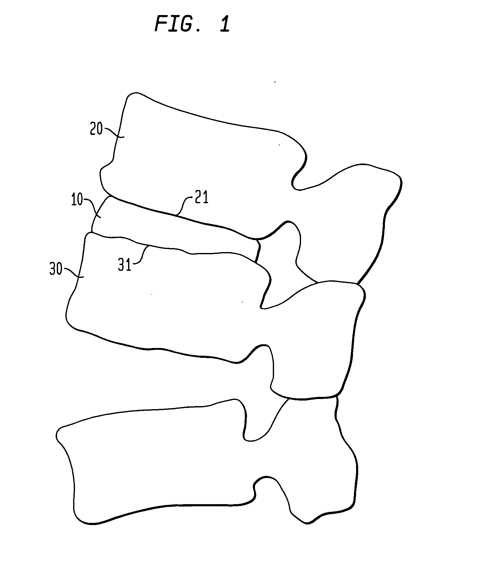 Spinal implant apparatus and methods