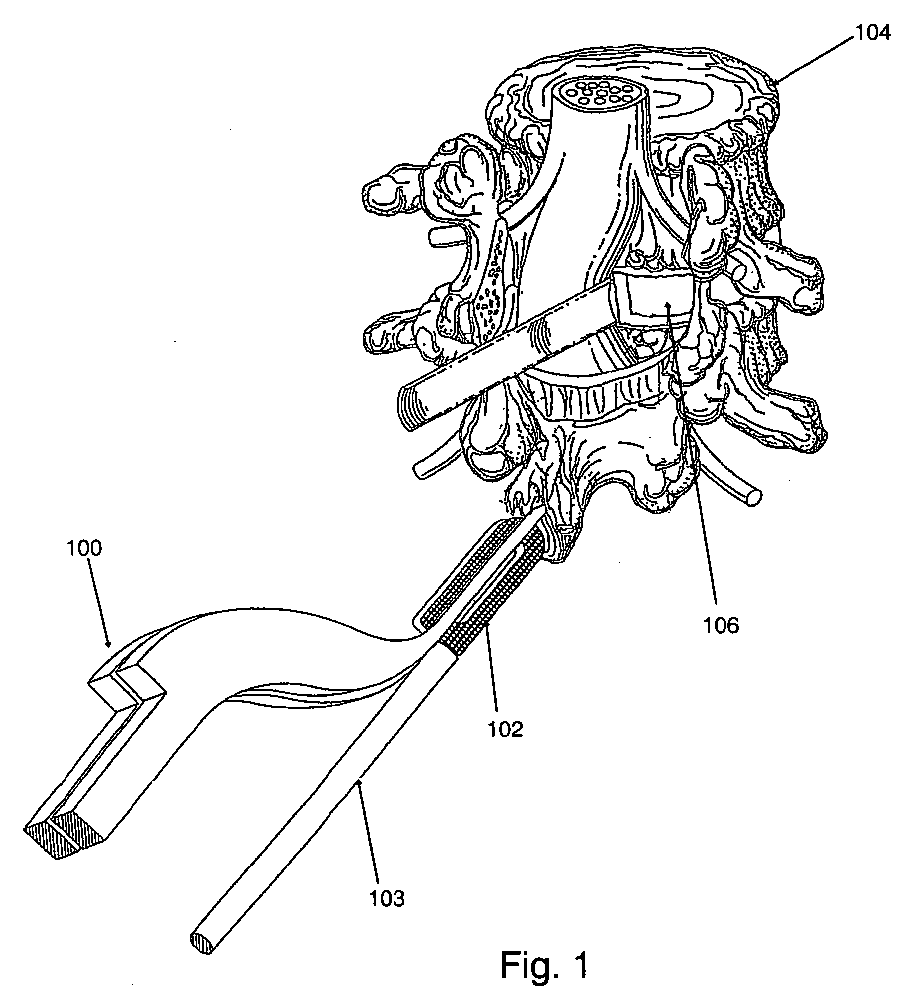 Spinal implant apparatus, method and system