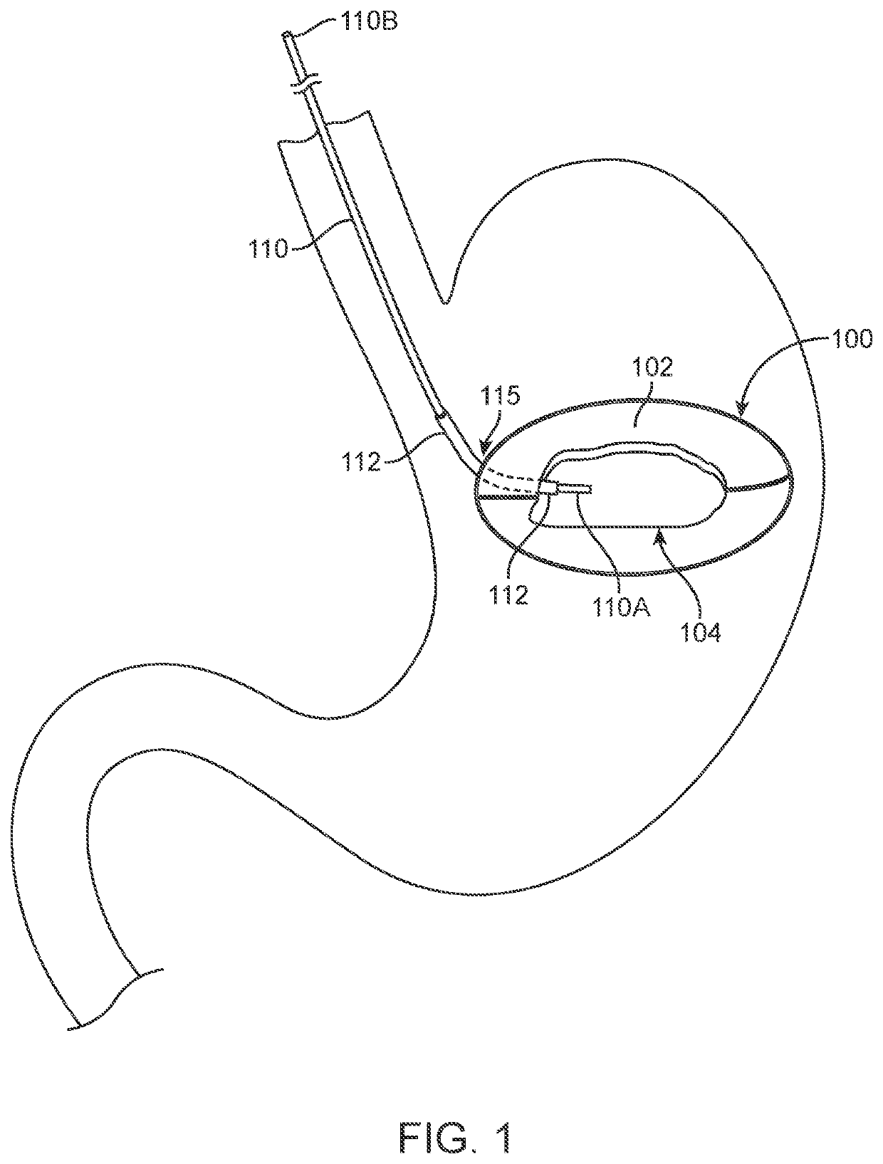 Enhanced fluid delivery system