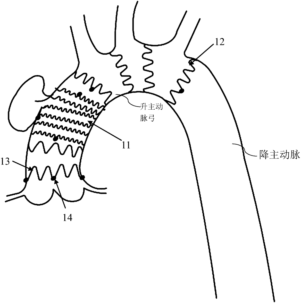 A kind of ascending aorta endoluminal isolation and transplantation device