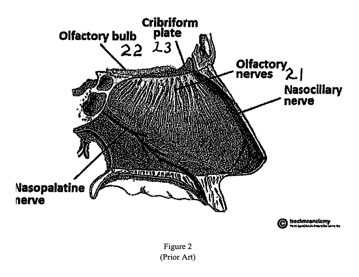 Formulation, apparatus, and methods for treatment of brain trauma