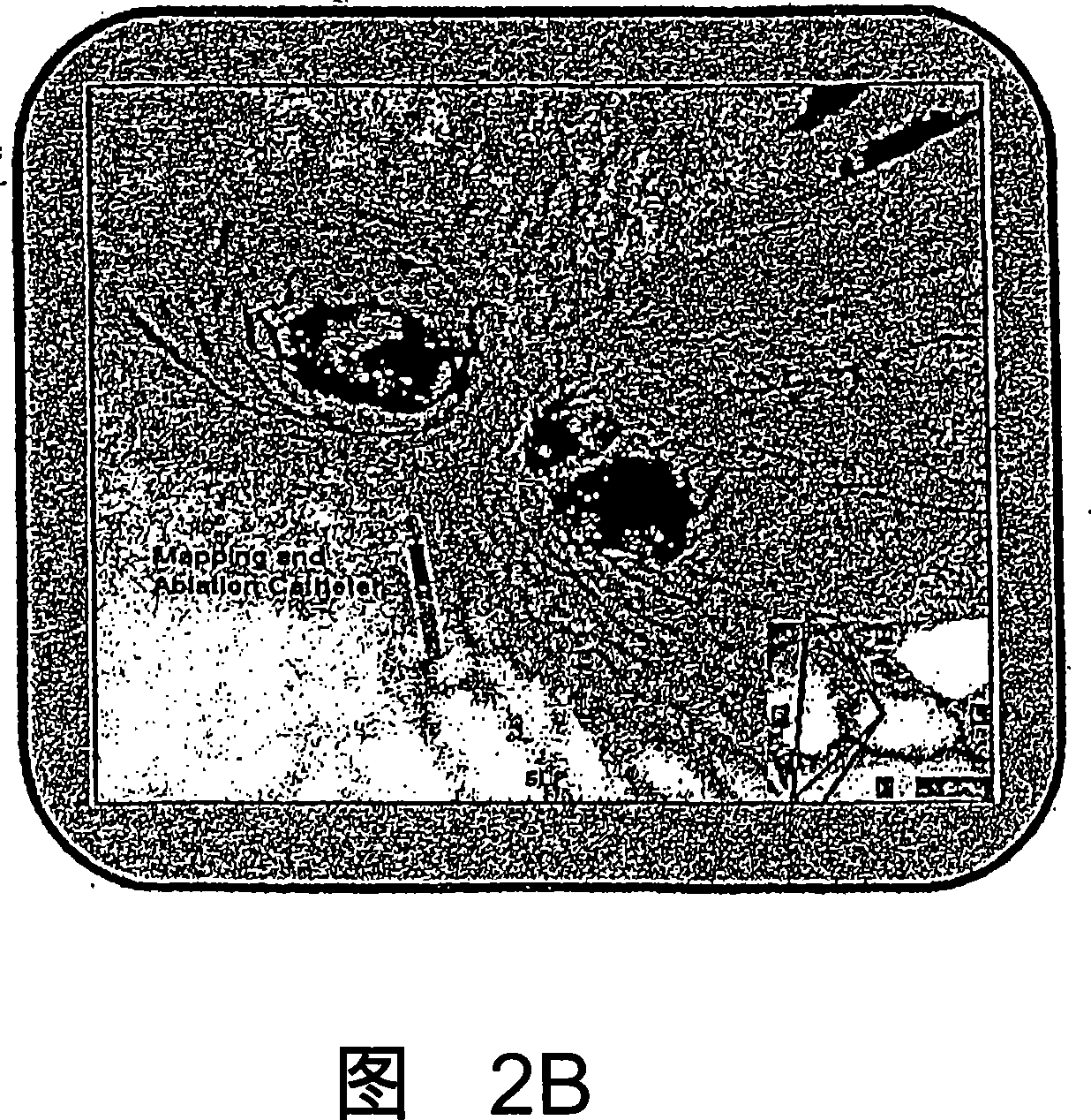 Method and system for treatment of atrial fibrillation and other cardiac arrhythmias