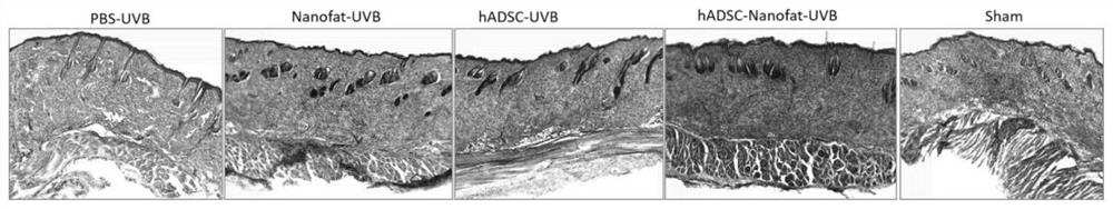 Preparation method of proportion mixture of adipose-derived mesenchymal stem cells and nano fat