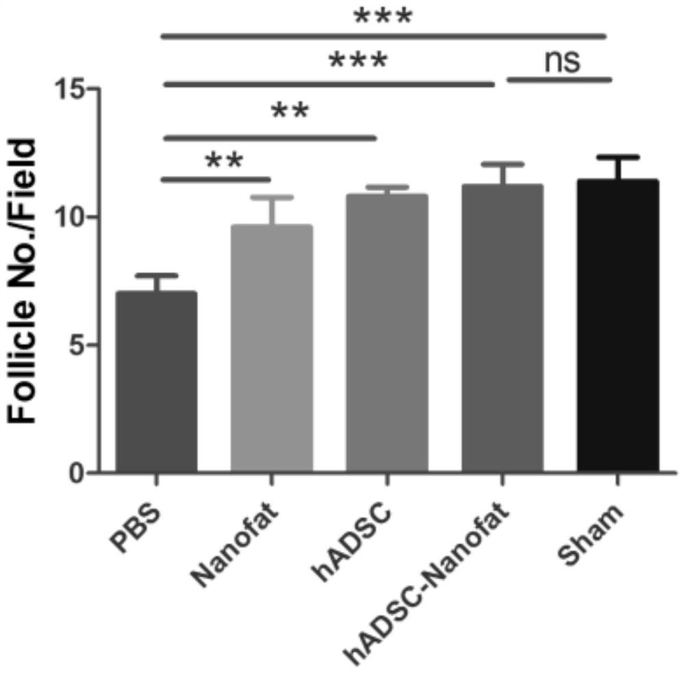 Preparation method of proportion mixture of adipose-derived mesenchymal stem cells and nano fat