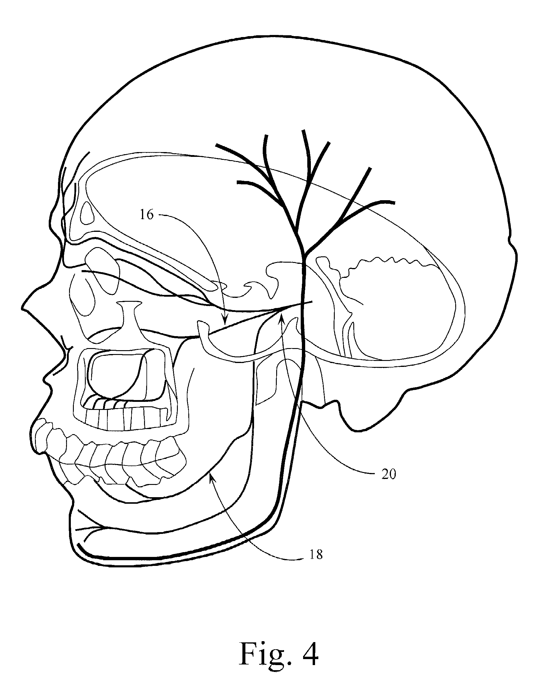 Trigeminal Nerve Stimulation Systems and Methods of Use