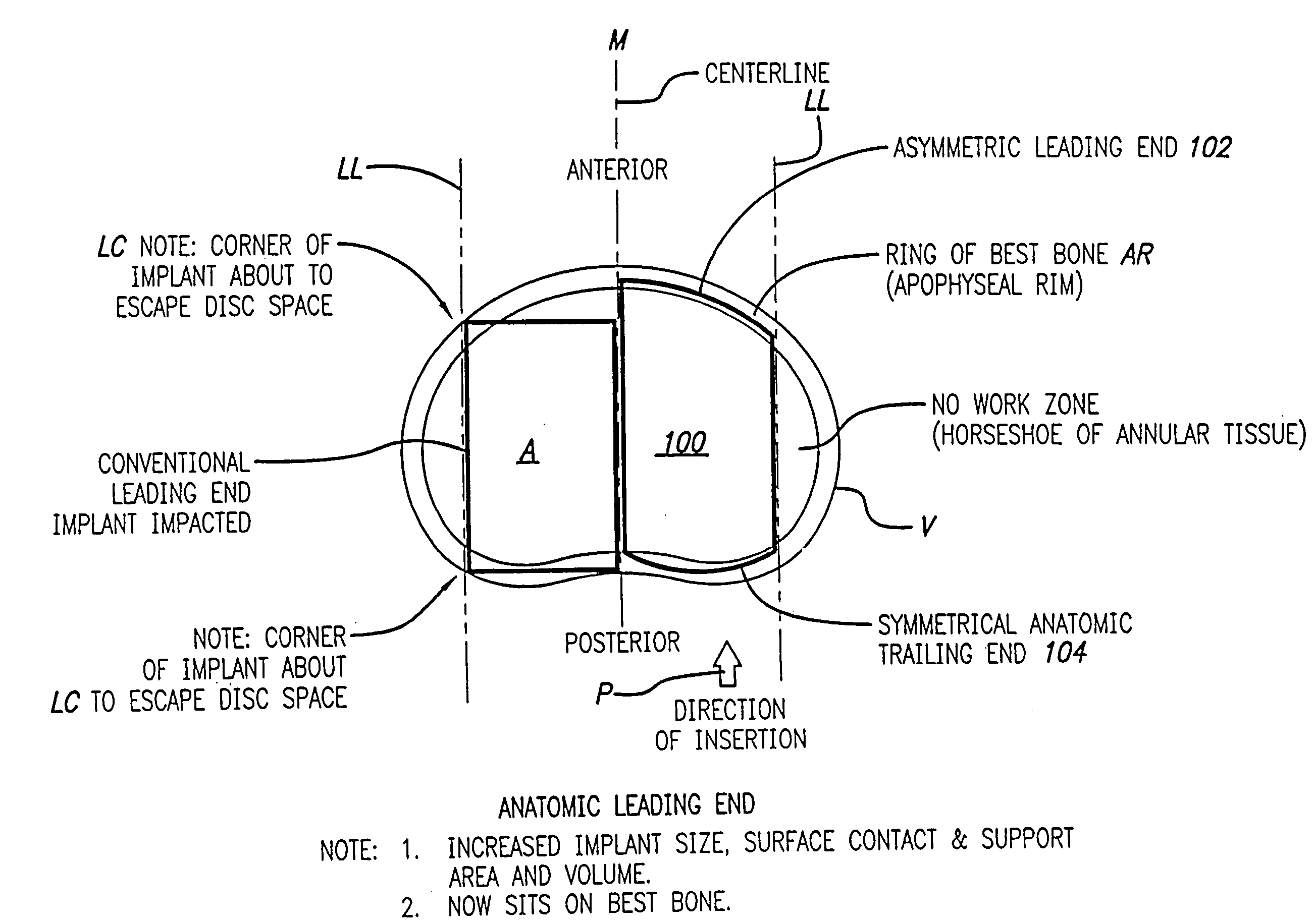 Bone hemi-lumbar arcuate interbody spinal fusion implant having an asymmetrical leading end