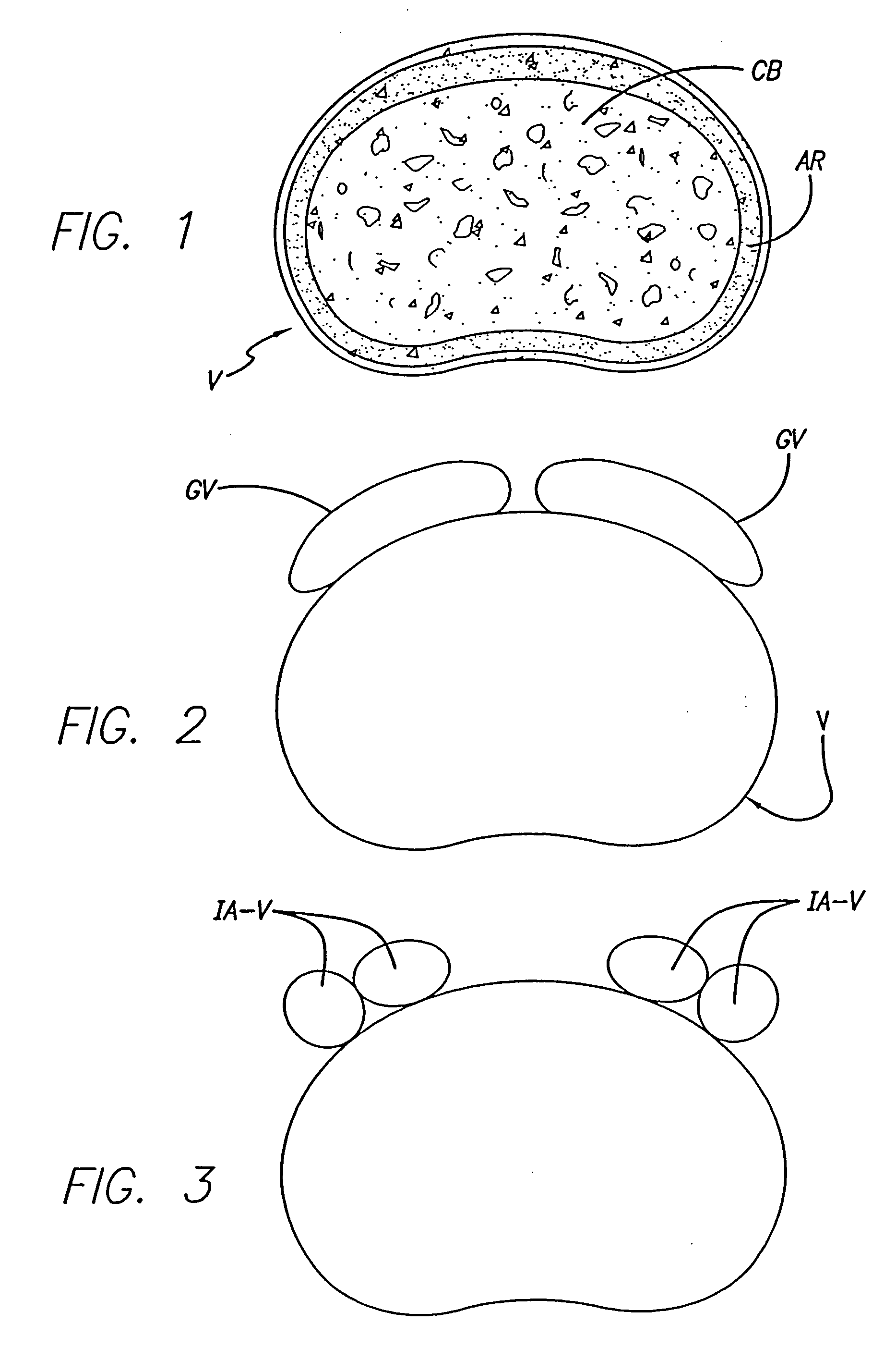 Bone hemi-lumbar arcuate interbody spinal fusion implant having an asymmetrical leading end