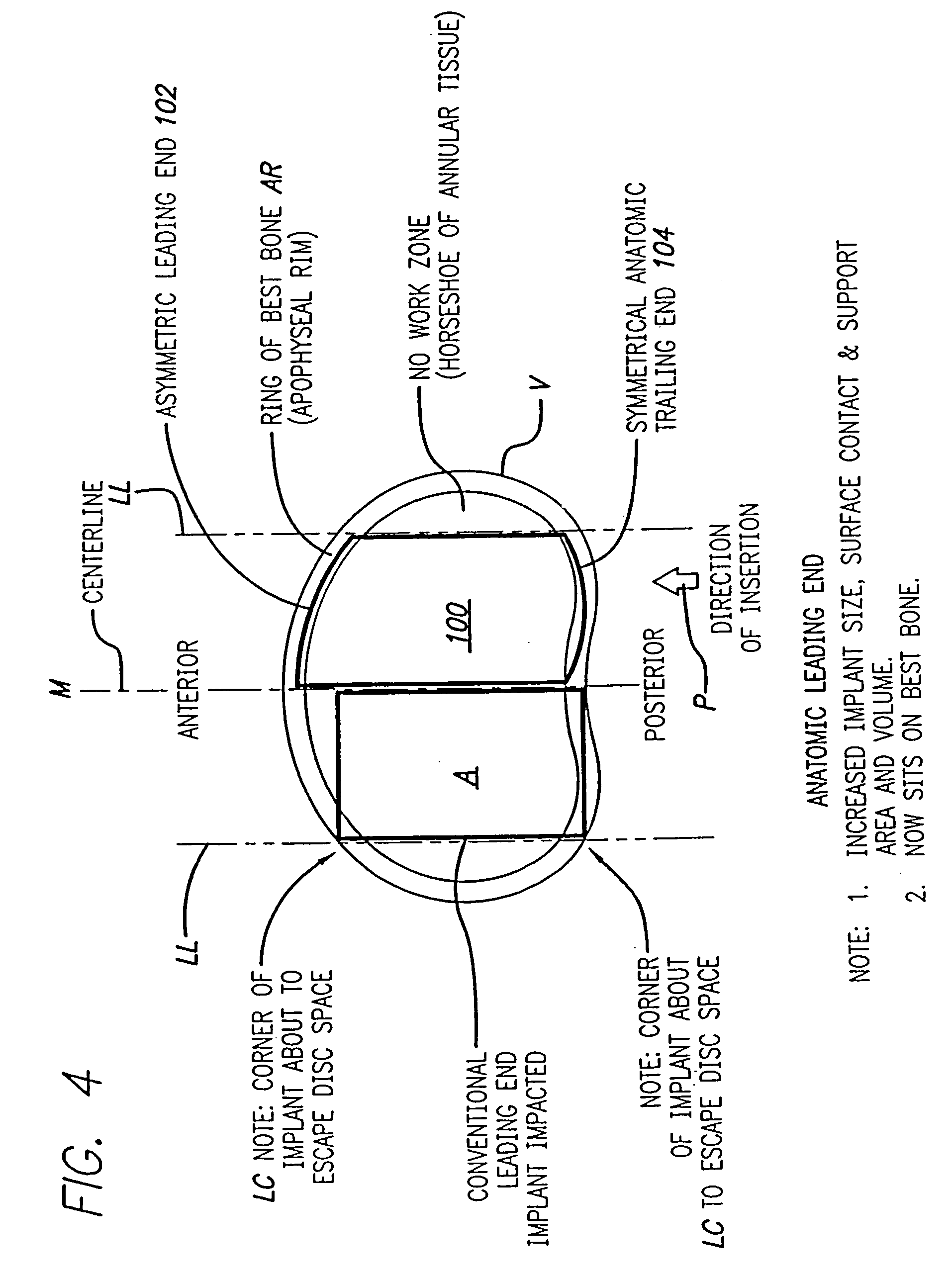 Bone hemi-lumbar arcuate interbody spinal fusion implant having an asymmetrical leading end