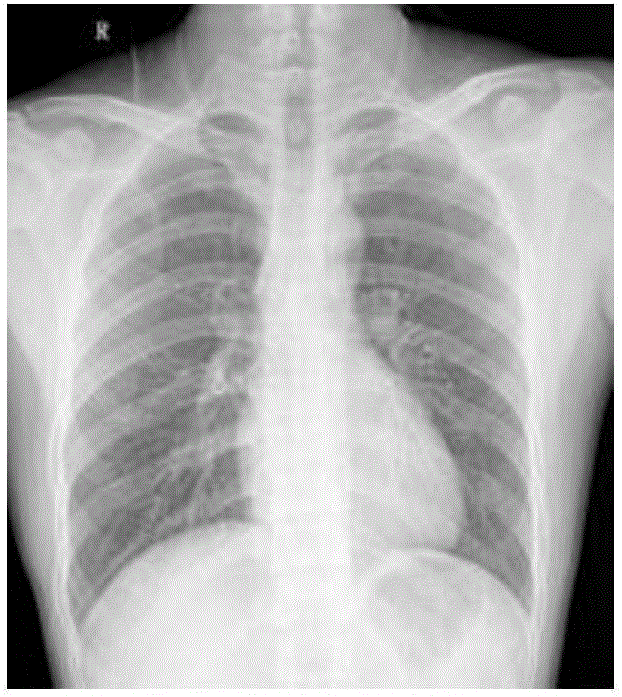 Method for extracting lung lobe contour from DR image