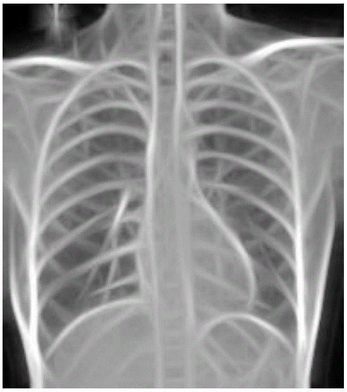 Method for extracting lung lobe contour from DR image