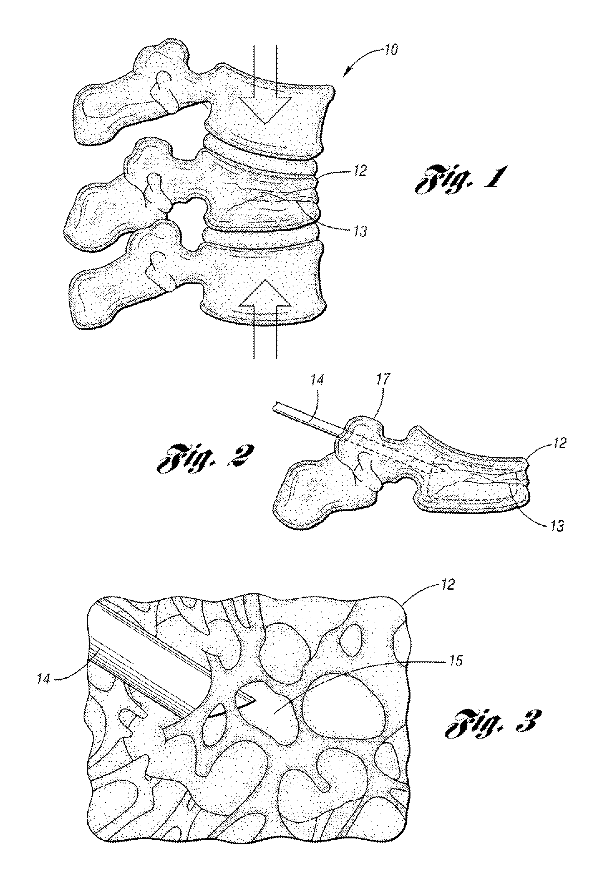 Bone cement mixing and delivery device and method of use