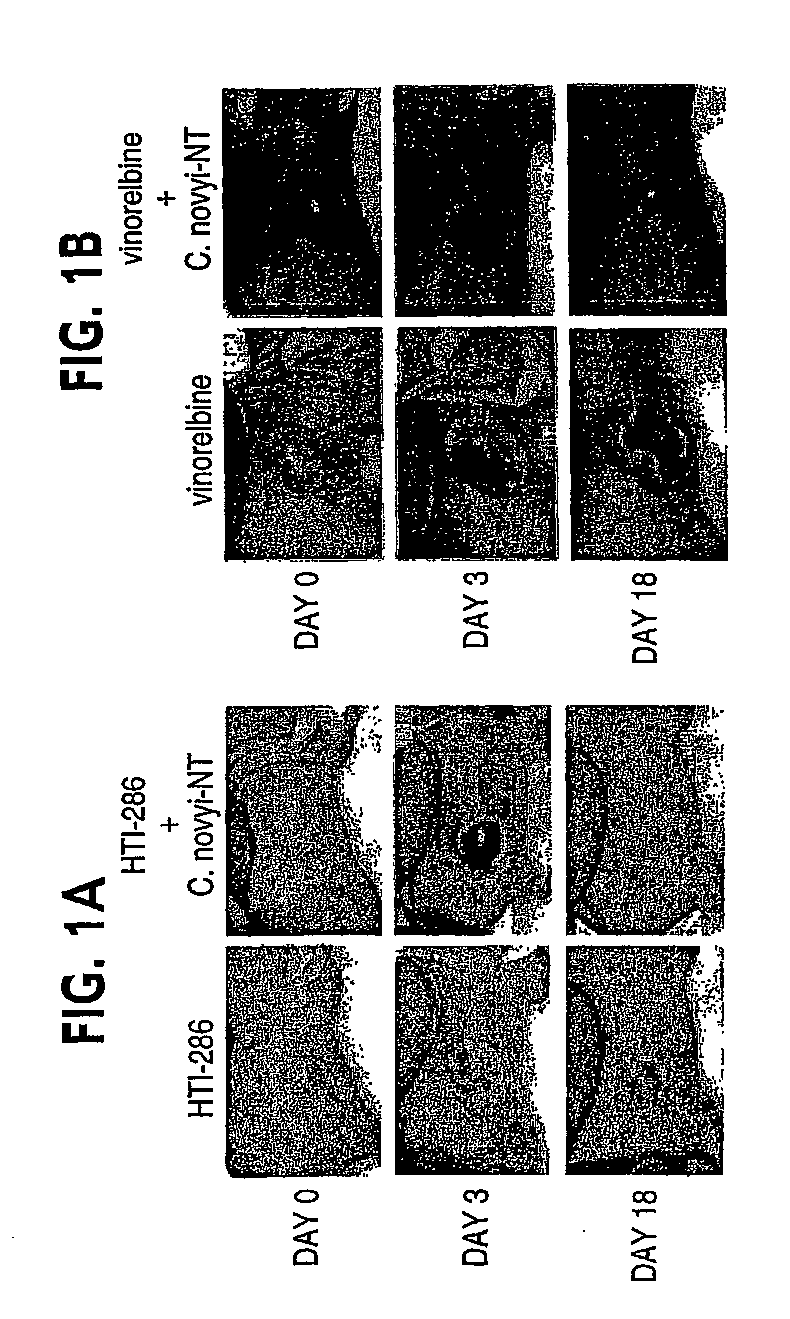 Combination bacteriolytic therapy for the treatment of tumors