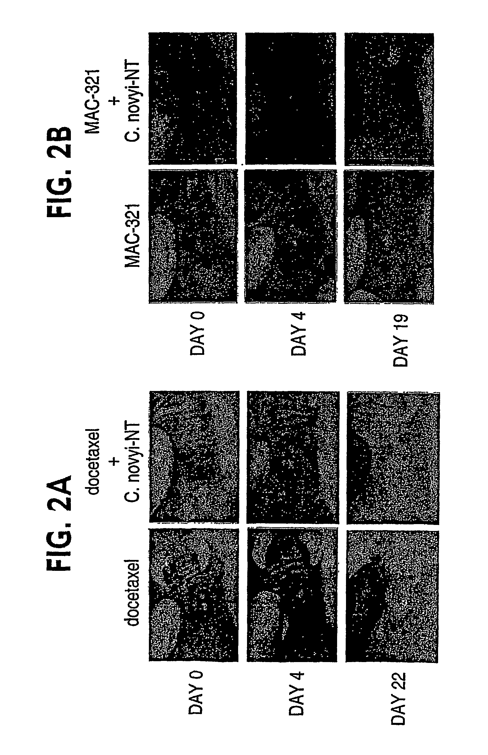 Combination bacteriolytic therapy for the treatment of tumors