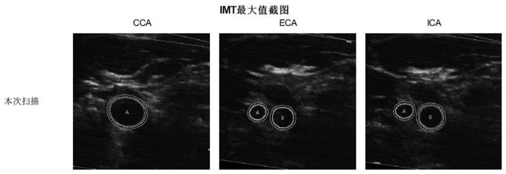 Carotid artery ultrasonic image processing method and device, storage medium and ultrasonic equipment