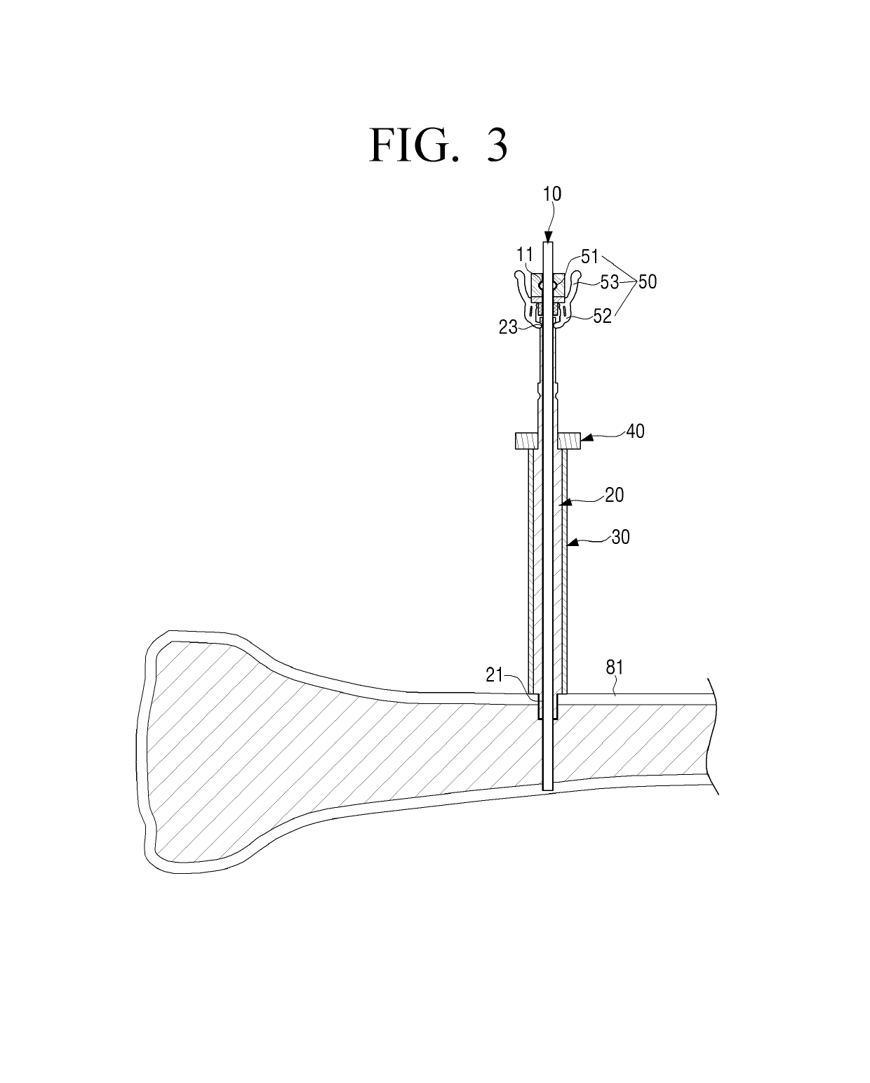 Fixing pin for orthopedic surgery enabling internal fixation