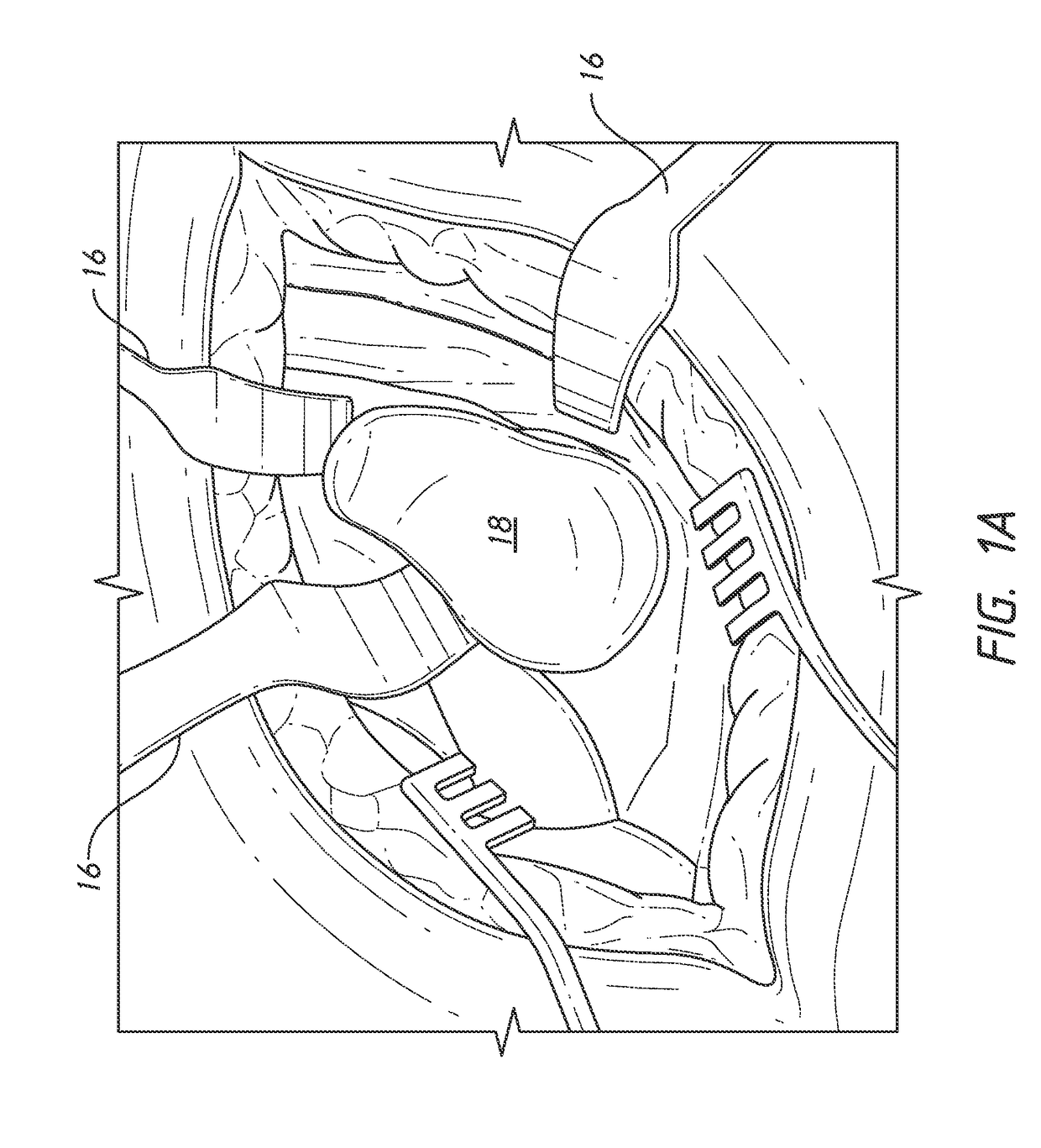 Guides and instruments for improving accuracy of glenoid implant placement