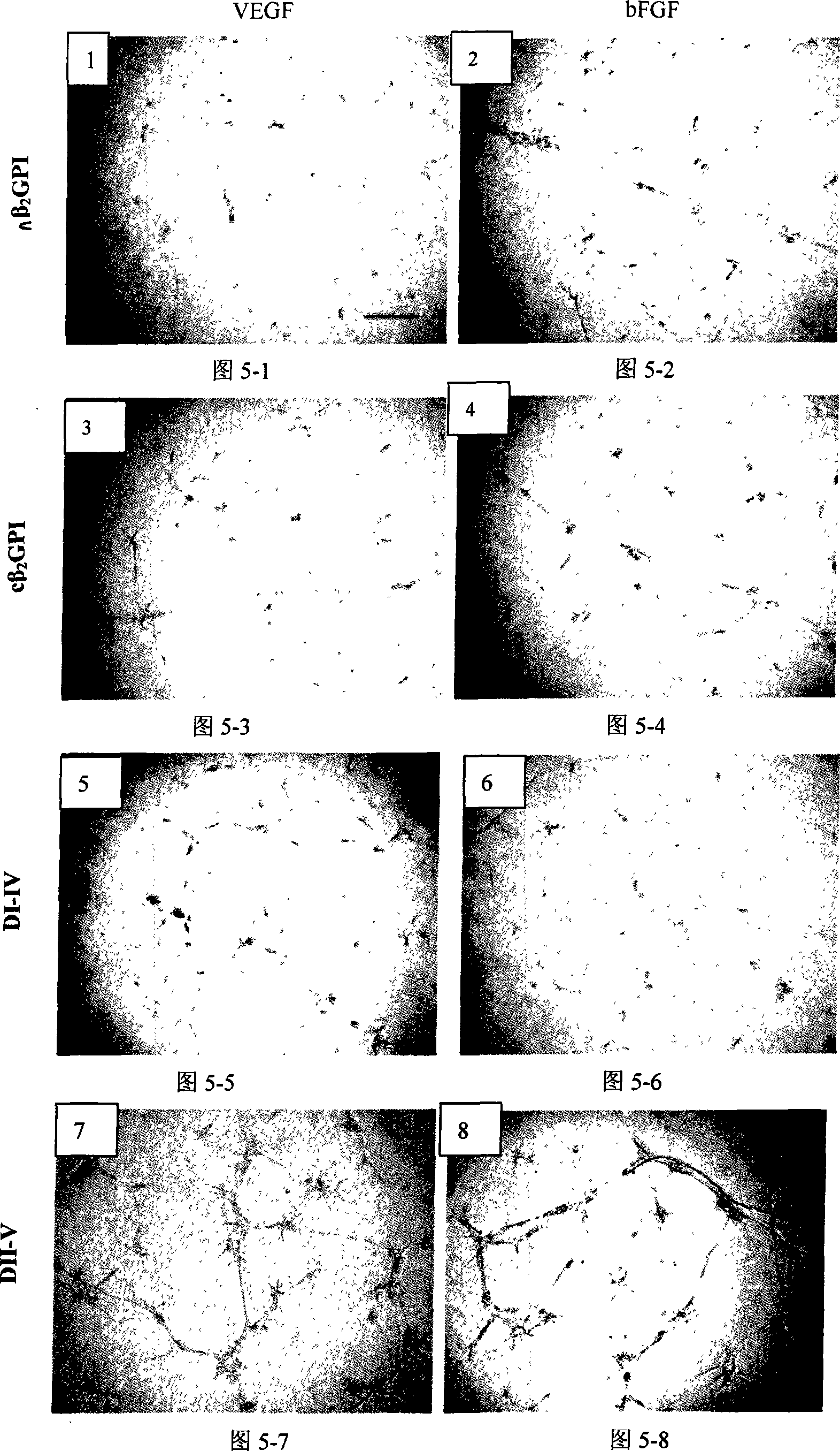 Application of natural type, breaking type or No. 5 domain delation variant type beta 2 glycoprotein I in preparing medicine for inhibiting blood vessel newborn